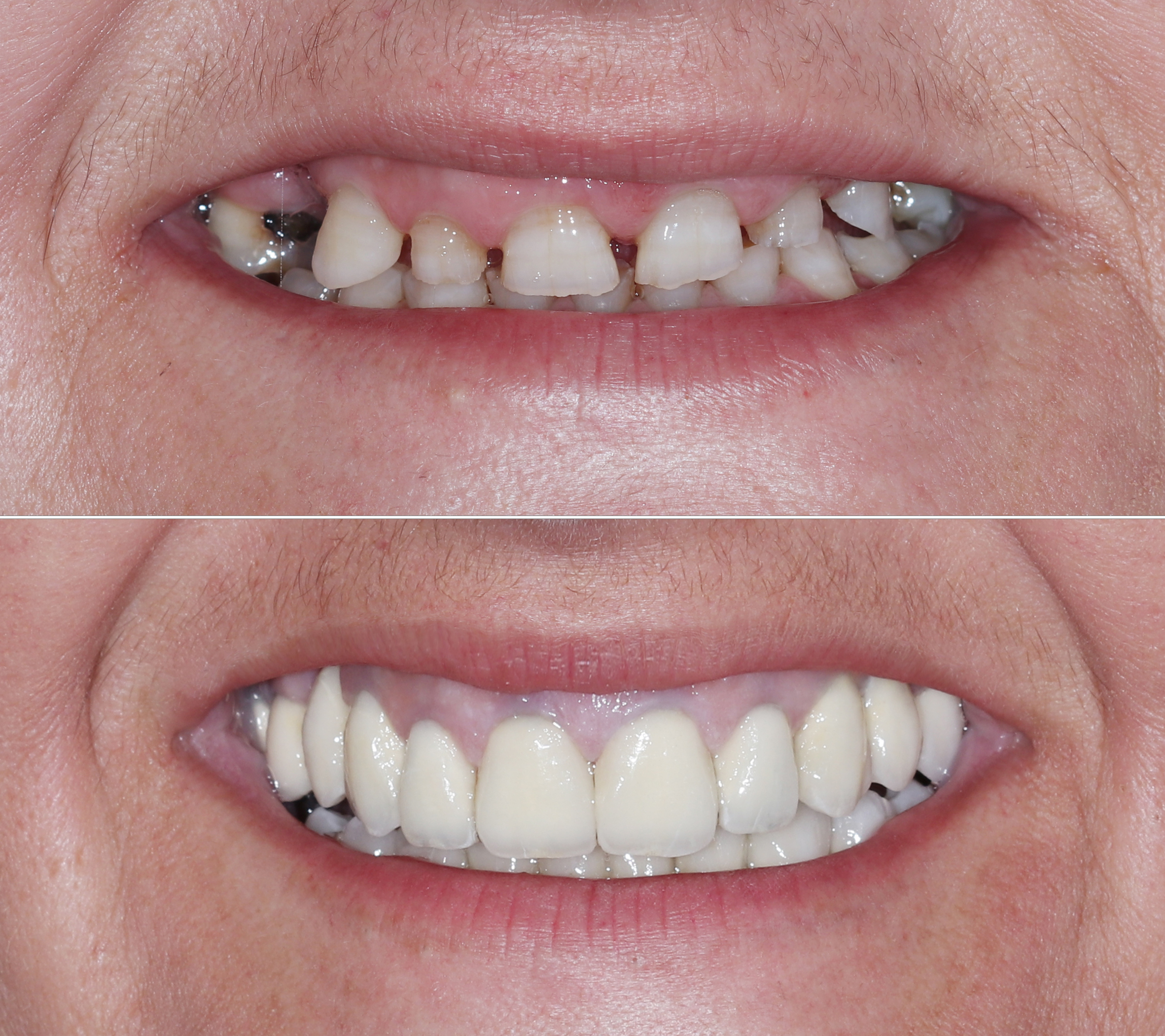 Σύγκριση αρχικής και τελικής κατάστασης – Το χαμόγελο της ασθενούς πριν και μετά την αποκατάσταση