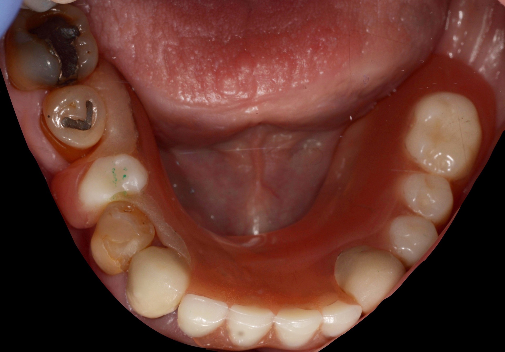 Αρχική κατάσταση - Μασητική άποψη (κάτω γνάθος).