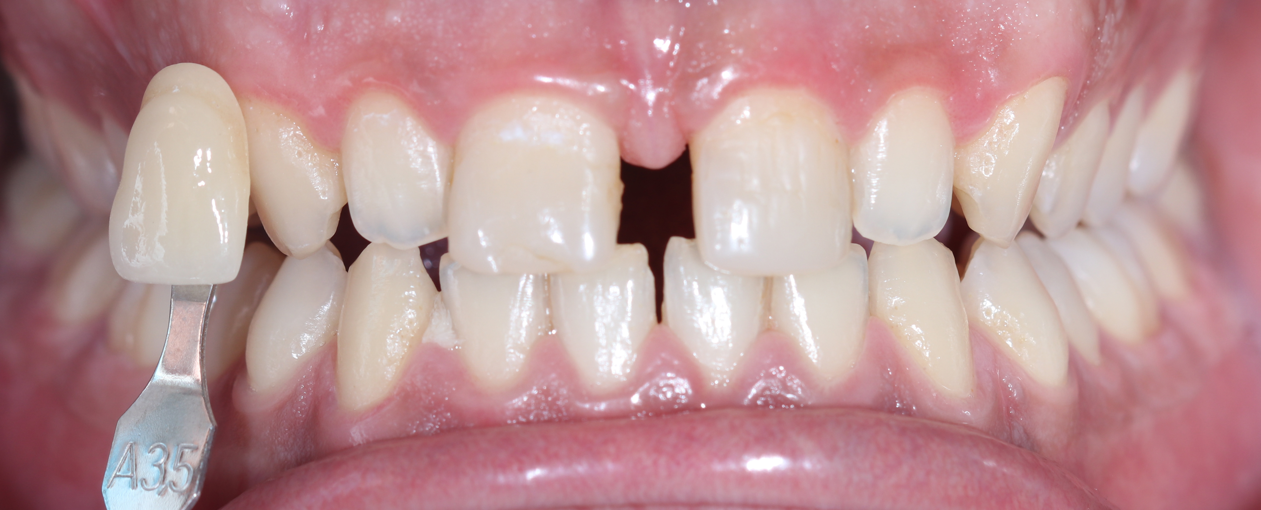 Αρχική κατάσταση - Χρωματοληψία πριν από την λεύκανση