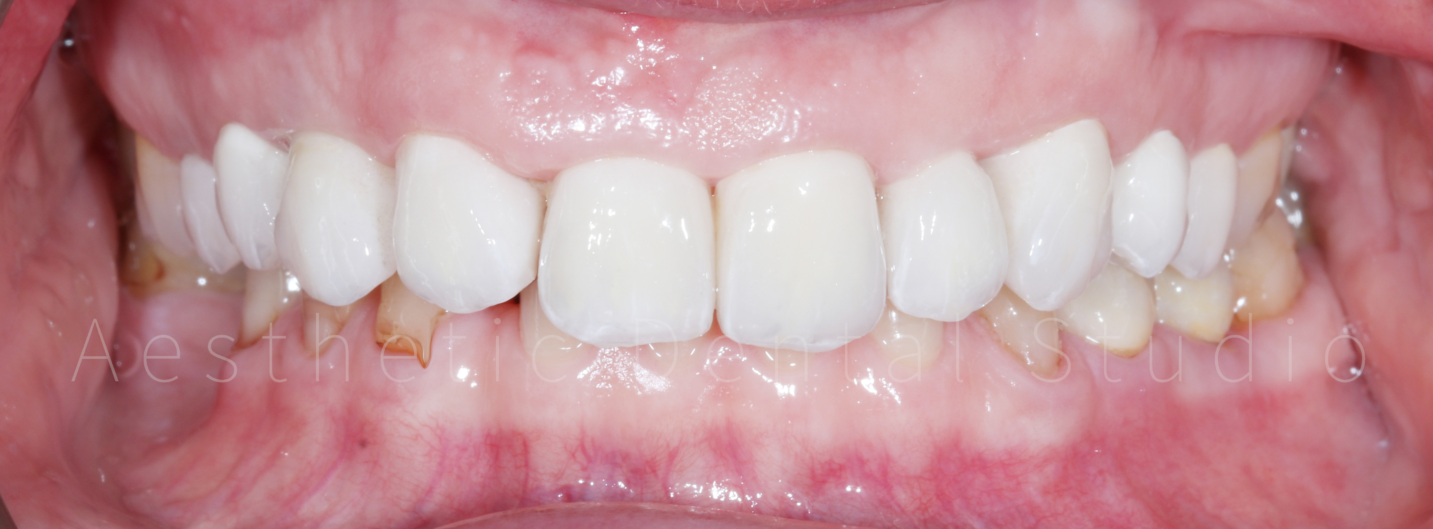 Τελική ενδοστοματική εικόνα – Οι ολοκεραμικές αποκαταστάσεις αποδίδουν φυσική απόχρωση και άψογη ενσωμάτωση με τους παρακείμενους ιστούς, προσφέροντας ένα αρμονικό και ρεαλιστικό αποτέλεσμα