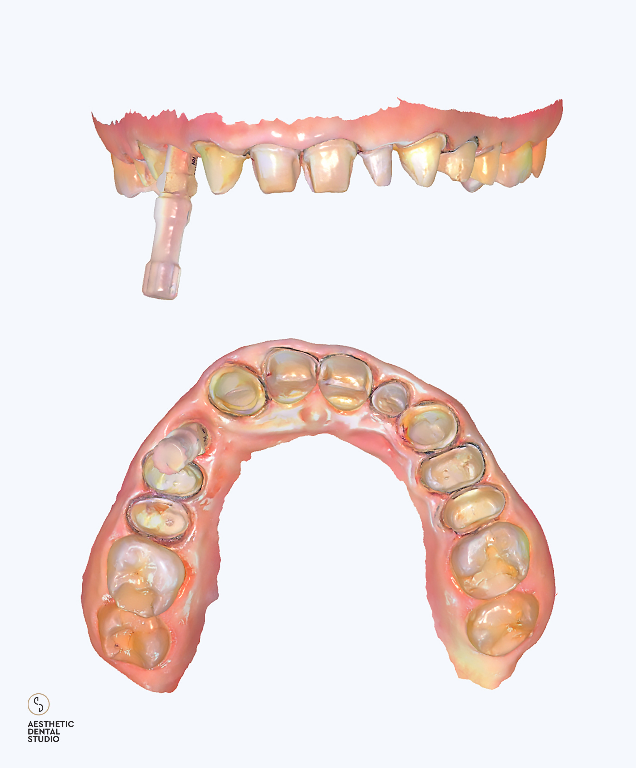 Ψηφιακή αποτύπωμα της άνω γνάθου – Ενδοστοματική σάρωση και αρχικός ψηφιακός σχεδιασμός πριν την αισθητική αποκατάσταση