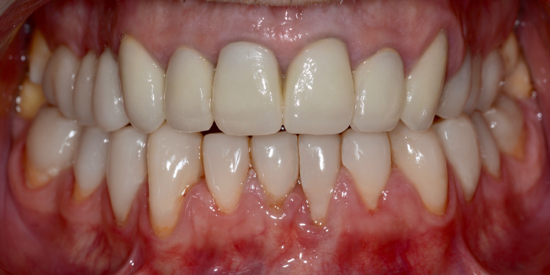 Τελική κατάσταση - Πρόσθια άποψη των αποκαταστάσεων τοποθετημένων στο στόμα - Αποκατάσταση της αισθητικής και της σύγκλεισης του ασθενούς