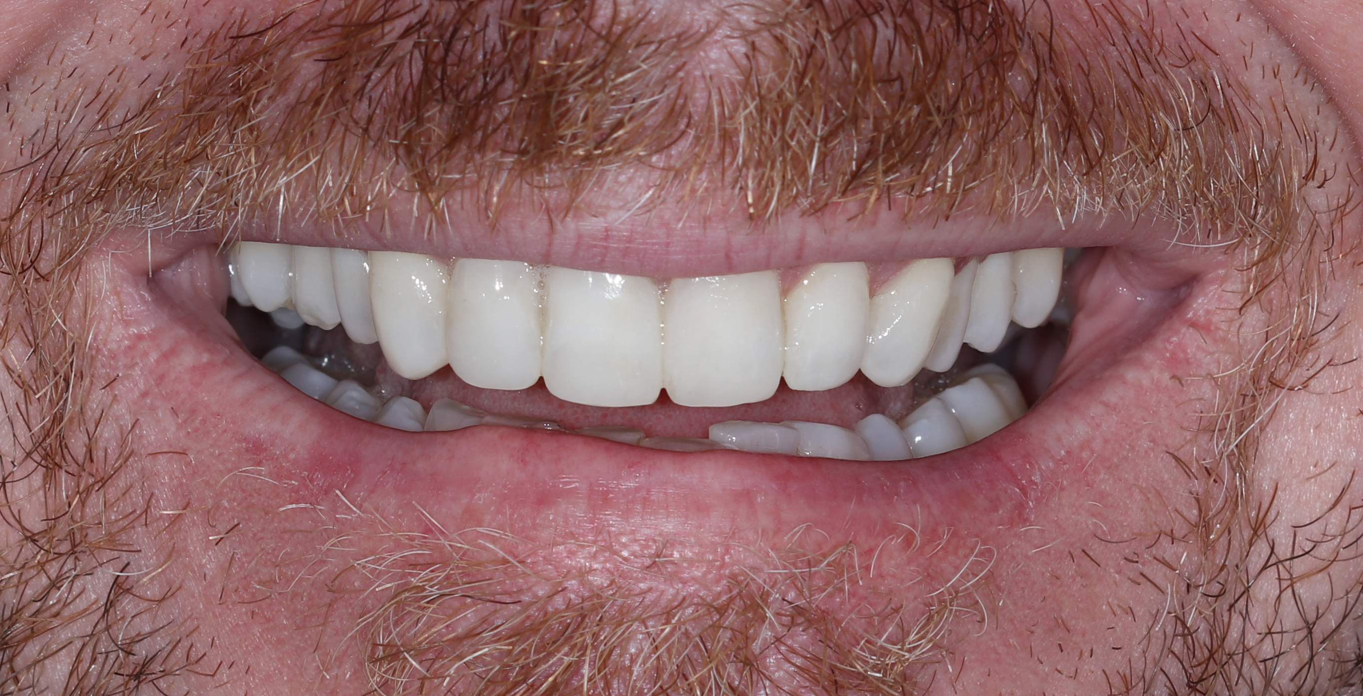 Χαμόγελο μετά την ολοκλήρωση της θεραπείας
