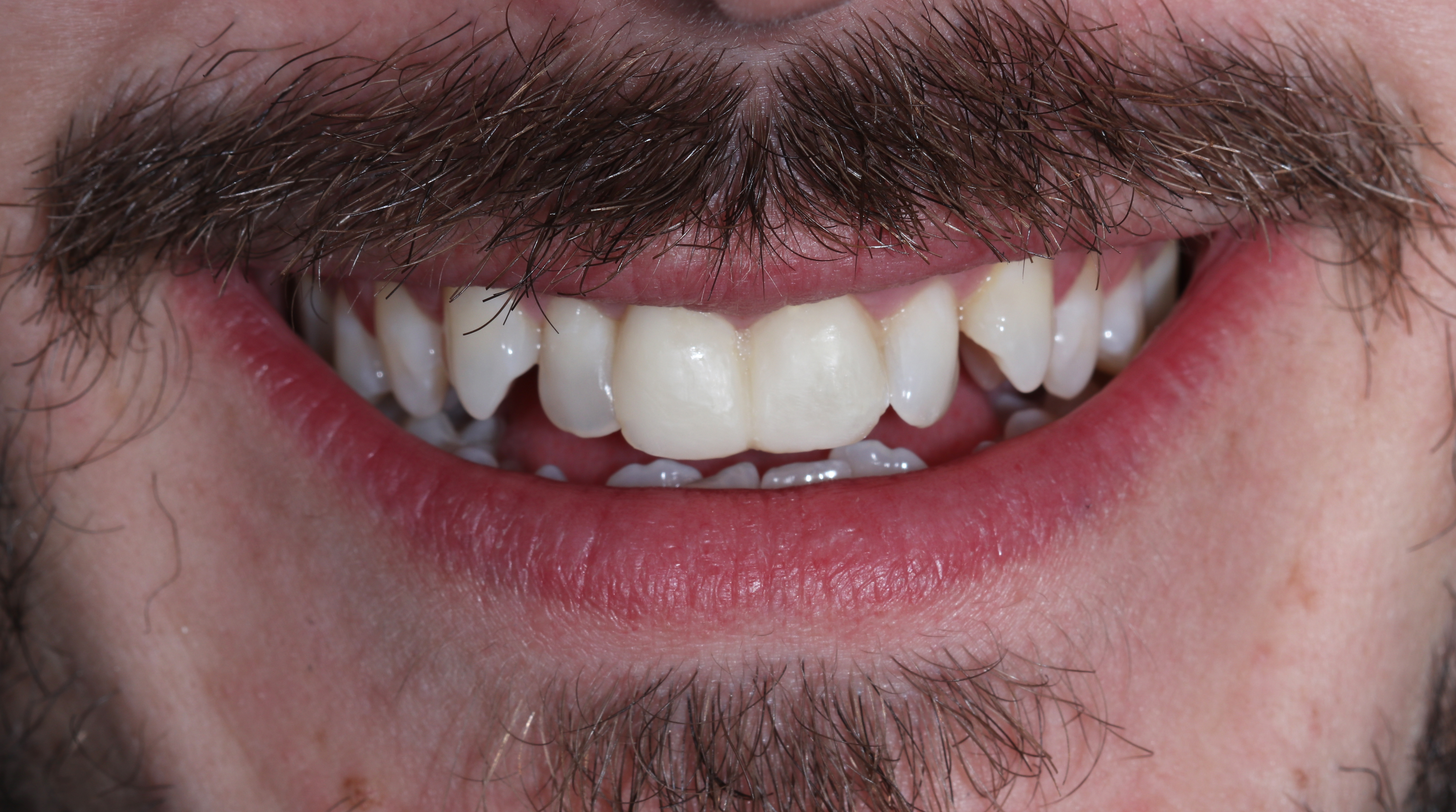 Οι προσωρινές αποκαταστάσεις τοποθετημένες στο στόμα μετά την παρασκευή των δοντιών - Πρόσθια άποψη