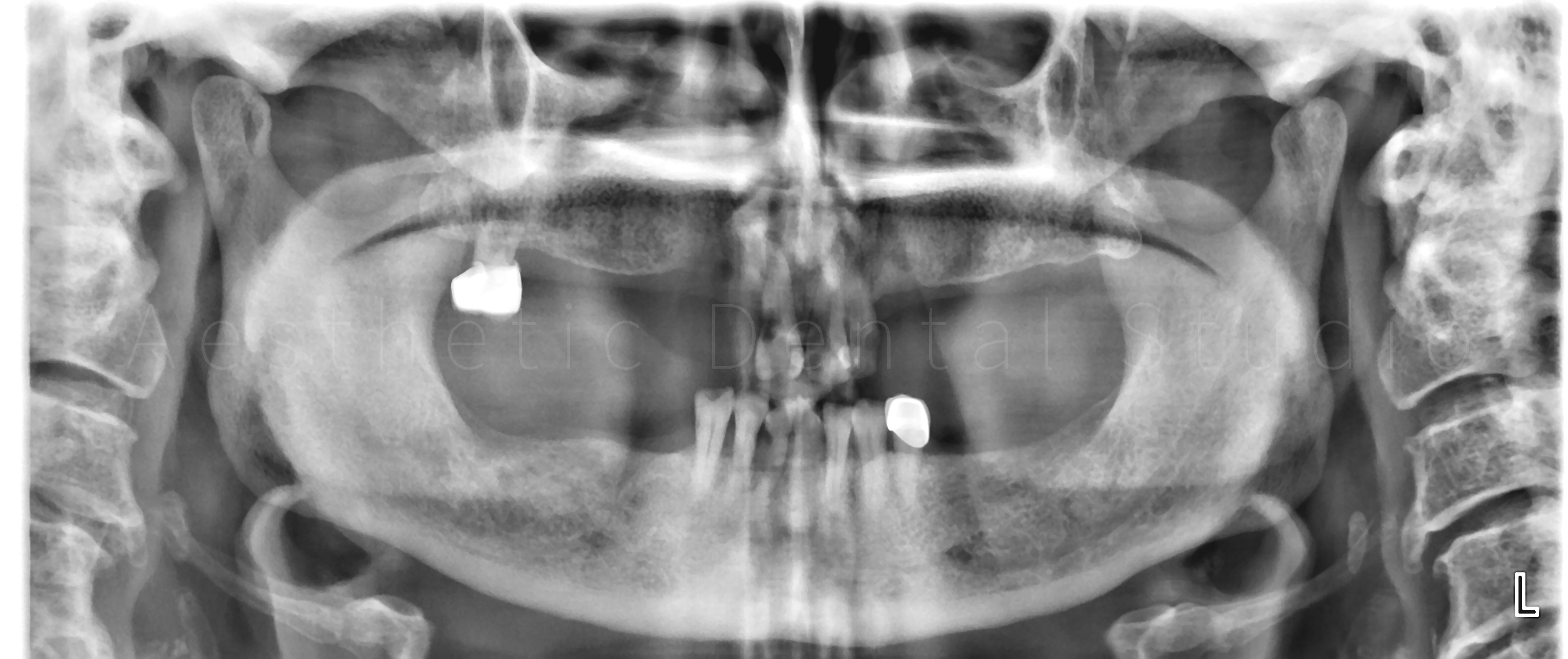 Αρχική πανοραμική ακτινογραφία — εκτεταμένες απώλειες δοντιών και οστικής υποστήριξης πριν την αποκατάσταση με εμφυτεύματα