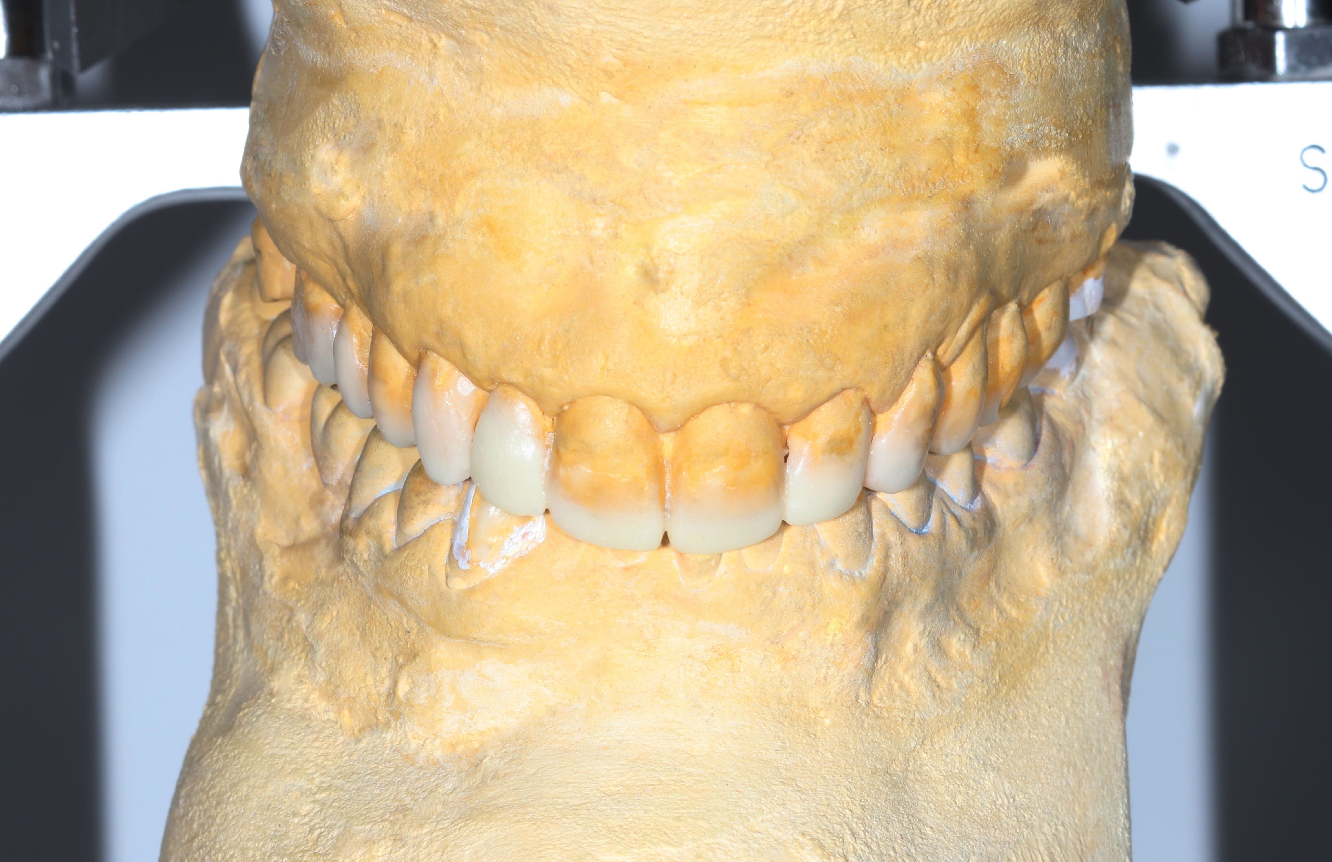 Το διαγνωστικό κέρωμα με βάση το οποίο εξετάσαμε την αισθητική των δοντιών και έγινε η συγκλεισιακή ανάλυση
