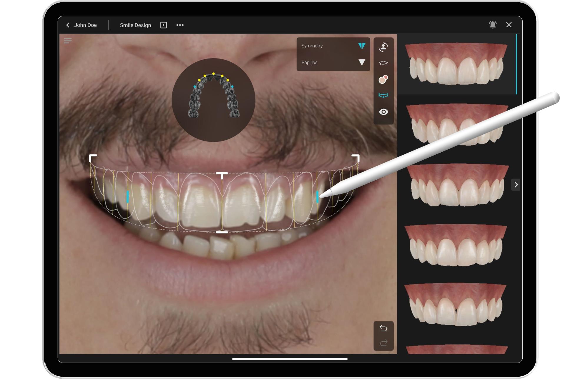 Το Digital Smile Design επιτρέπει τον ψηφιακό σχεδιασμό του νέου χαμόγελου πριν ξεκινήσει η θεραπεία, συνδυάζοντας αισθητική, λειτουργία και σύγχρονη τεχνολογία.