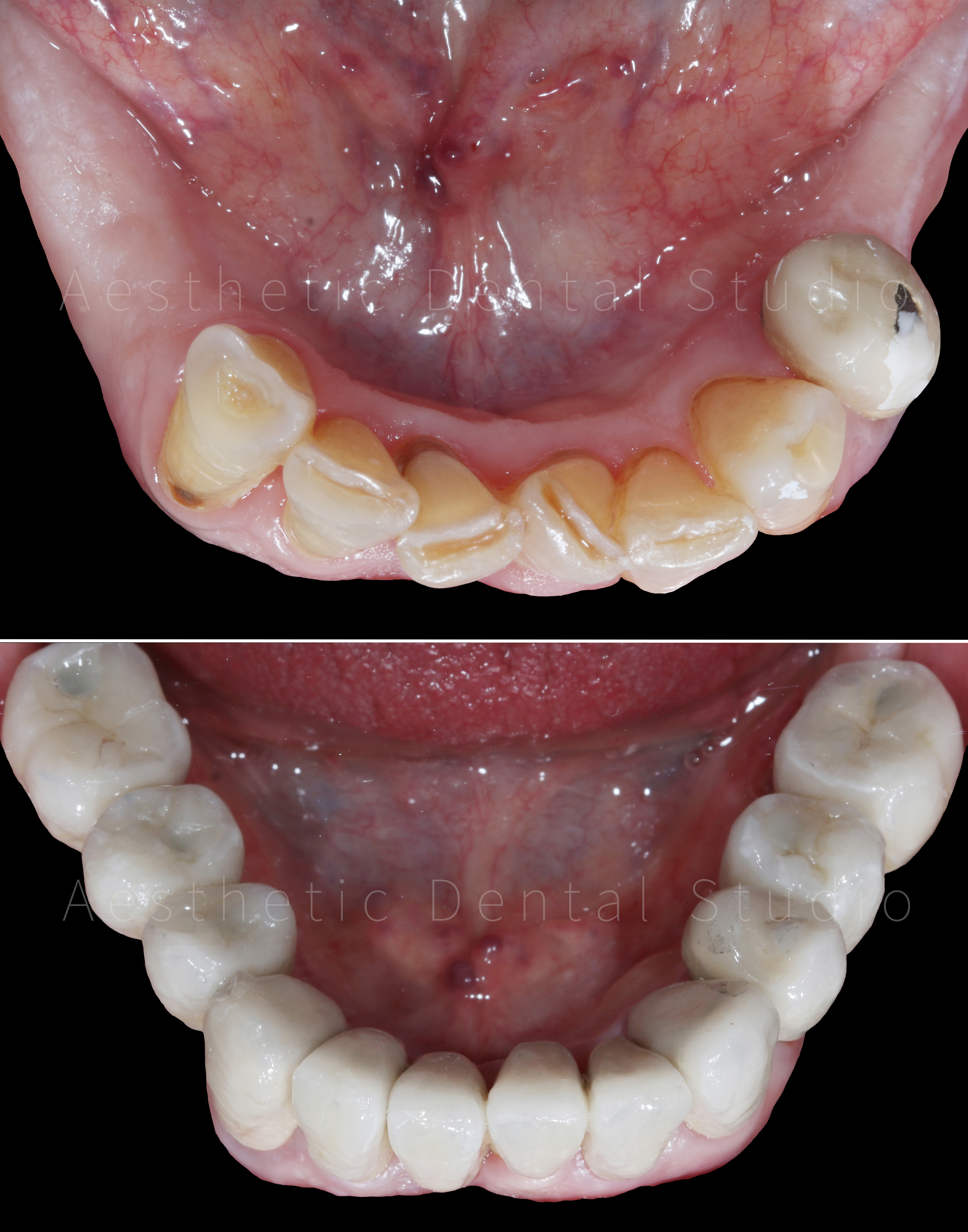 Κάτω γνάθος — αποκατάσταση μασητικής λειτουργίας και αισθητικής με κεραμικές στεφάνες και γέφυρες επί εμφυτευμάτων και δοντιών