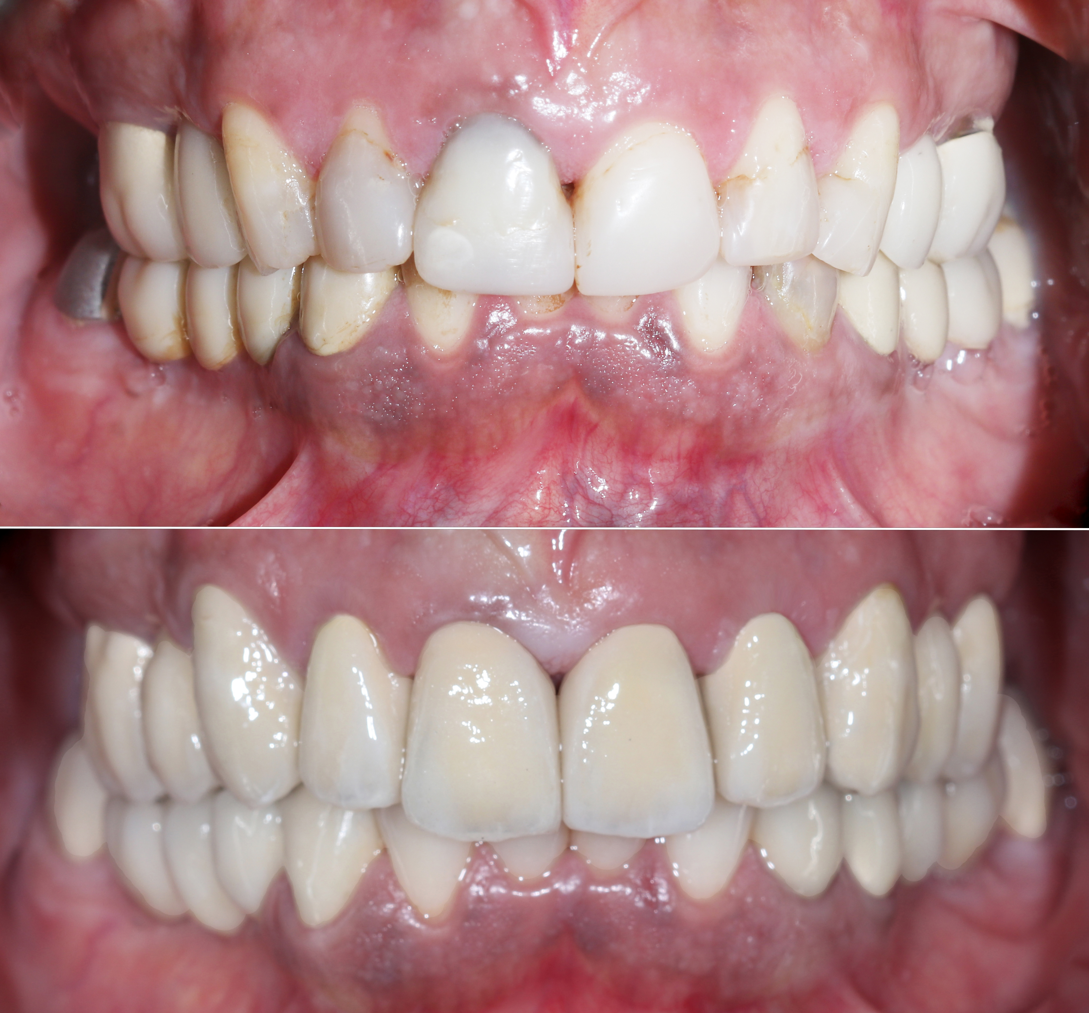 Σύγκριση αρχικής και τελικής κατάστασης – Πρόσθια άποψη