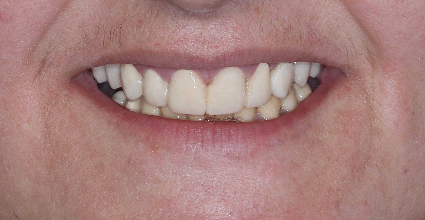 Μετά την παρασκευή (τροχισμό) των δοντιών στις δύο γνάθους, τοποθετήθηκαν προσωρινές ακρυλικές αποκαταστάσεις, πιστές στο ψηφιακό διαγνωστικό κέρωμα. Με αυτόν τον τρόπο μπορούμε να αξιολογήσουμε την επίδραση των τελικών αποκαταστάσεων στην αισθητική, τη μάσηση και τη φώνηση