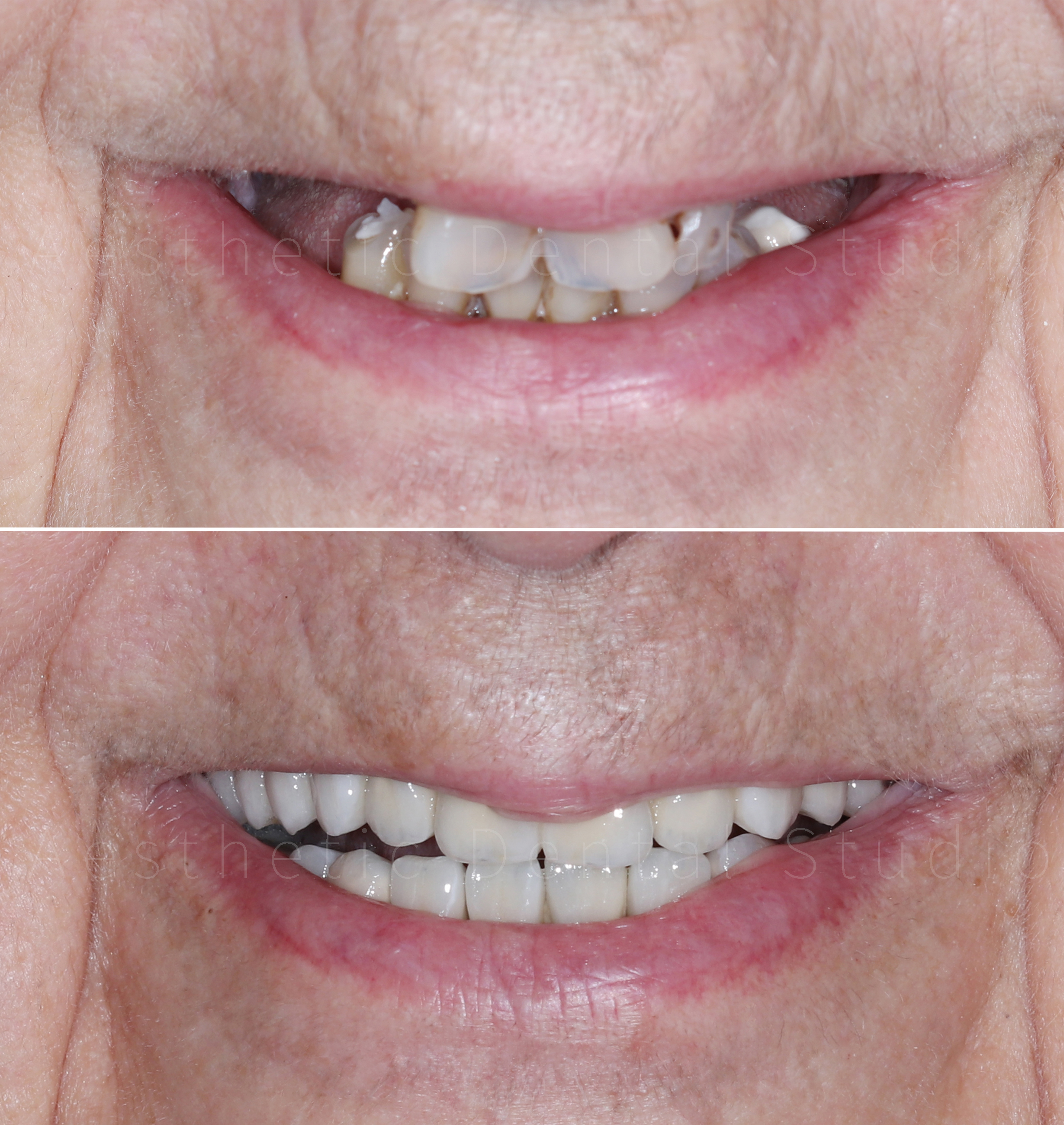 Σύγκριση χαμόγελου πριν και μετά — ολική αποκατάσταση στόματος με εμφυτεύματα και κεραμικές αποκαταστάσεις, για ένα φυσικό και σταθερό αποτέλεσμα
