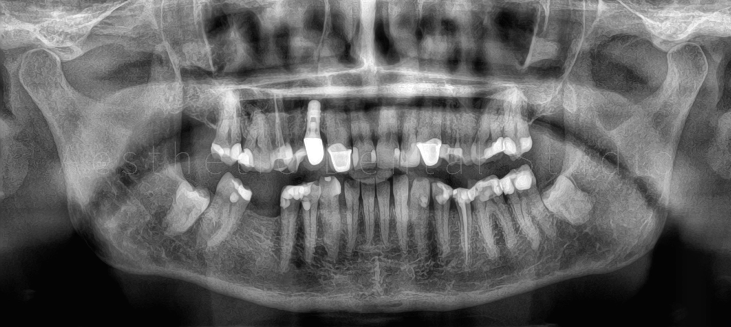 Αρχική πανοραμική ακτινογραφία – Πολλαπλές παλαιές αποκαταστάσεις, τερηδονισμένα δόντια και ένα εμφύτευμα σε καλή κατάσταση πριν τον σχεδιασμό της αισθητικής αποκατάστασης