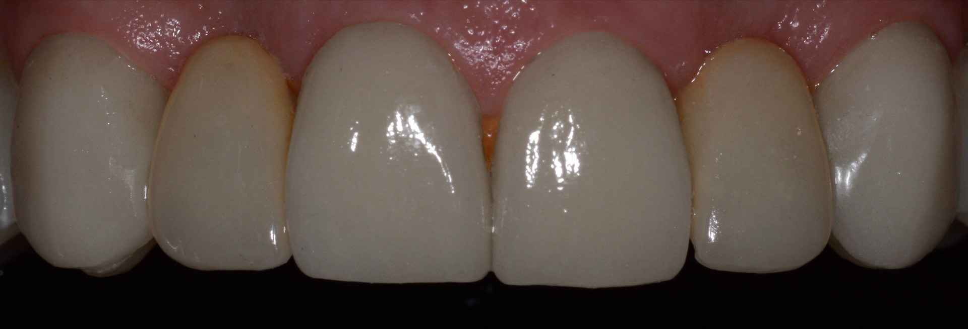 Τελική κατάσταση - Πρόσθια άποψη των αποκαταστάσεων της άνω γνάθου, τοποθετημένες στο στόμα