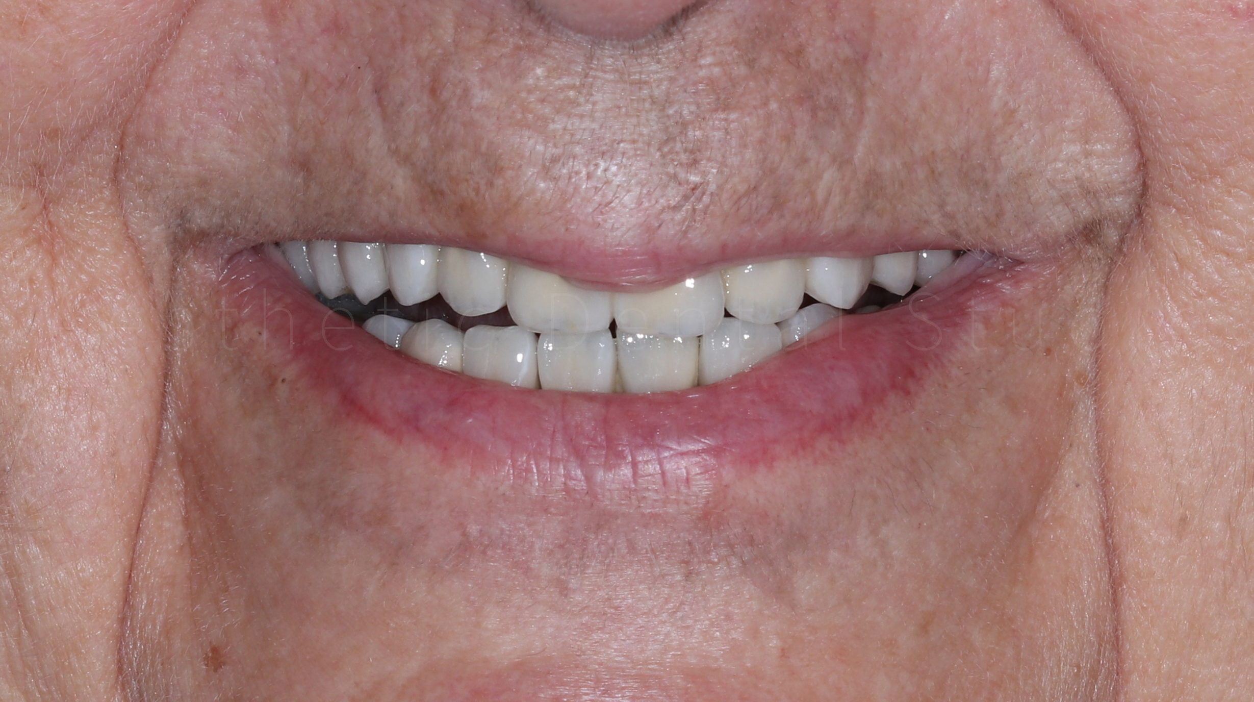 Τελικό αποτέλεσμα — ολοκληρωμένη αποκατάσταση με κεραμικές αποκαταστάσεις πάνω σε εμφυτεύματα και δόντια, με φυσική αισθητική και άριστη λειτουργικότητα