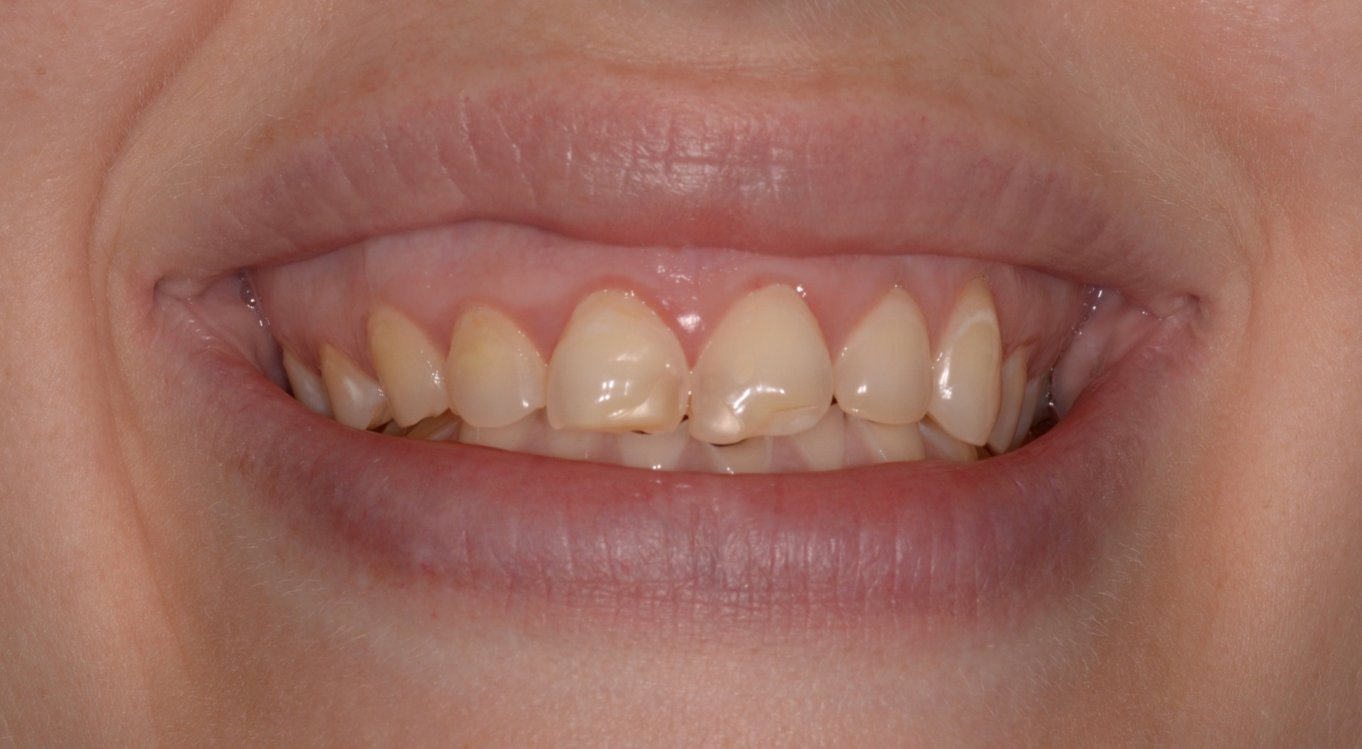 Αρχική κατάσταση - Χαμόγελο με υπερβολική έκθεση των ούλων (ουλοχαμόγελο).