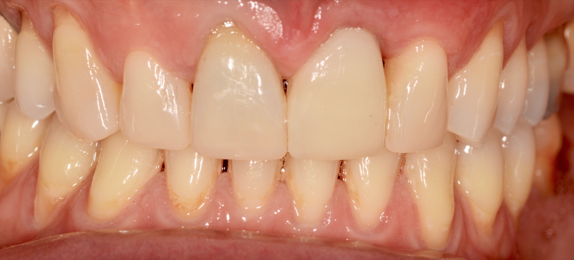 Τελική κατάσταση - Πρόσθια άποψη - Η τελική στεφάνη διπυριτικού λιθίου τοποθετημένη στο στόμα.