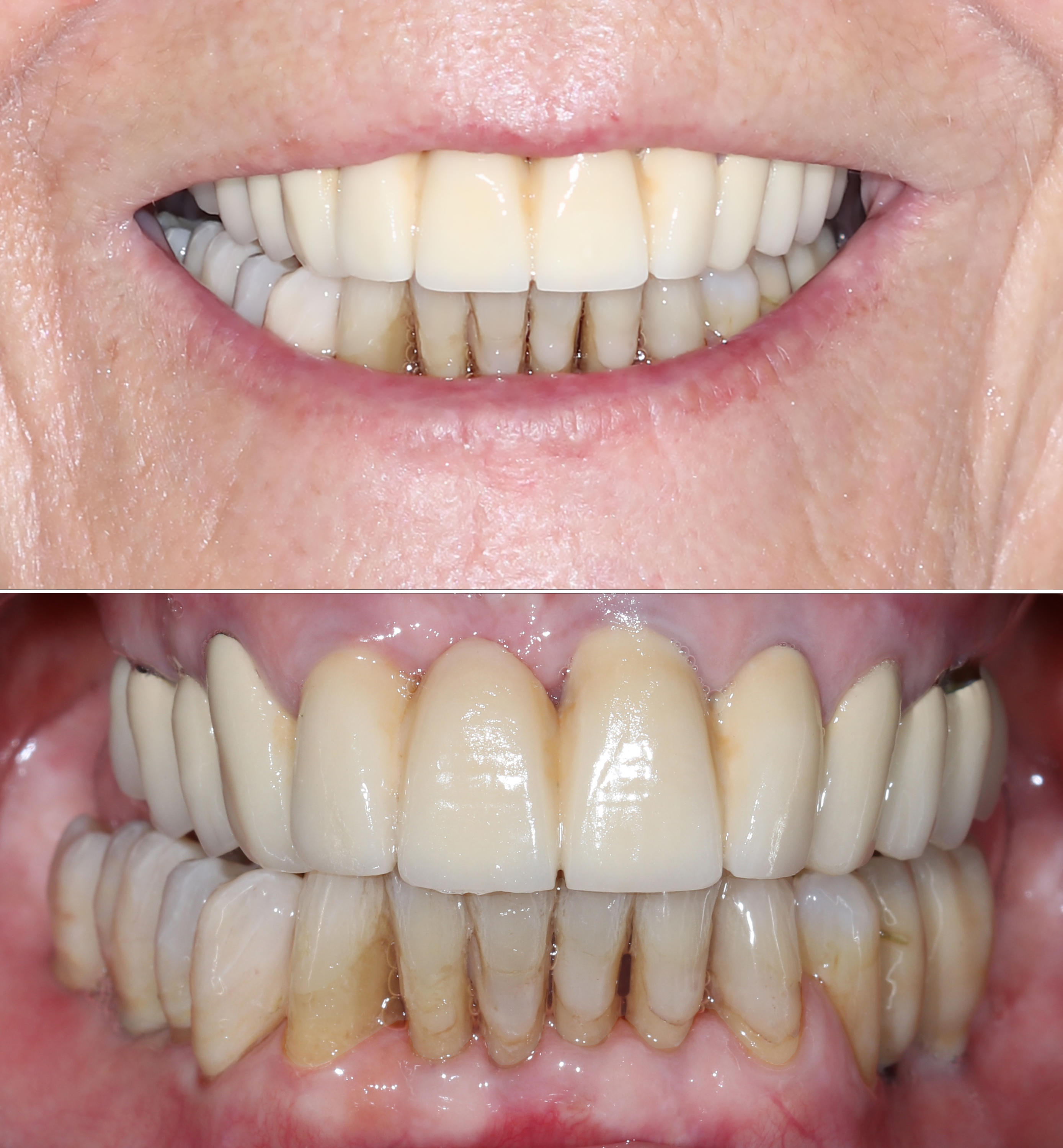 Τελική κατάσταση - Χαμόγελο και πρόσθια άποψη