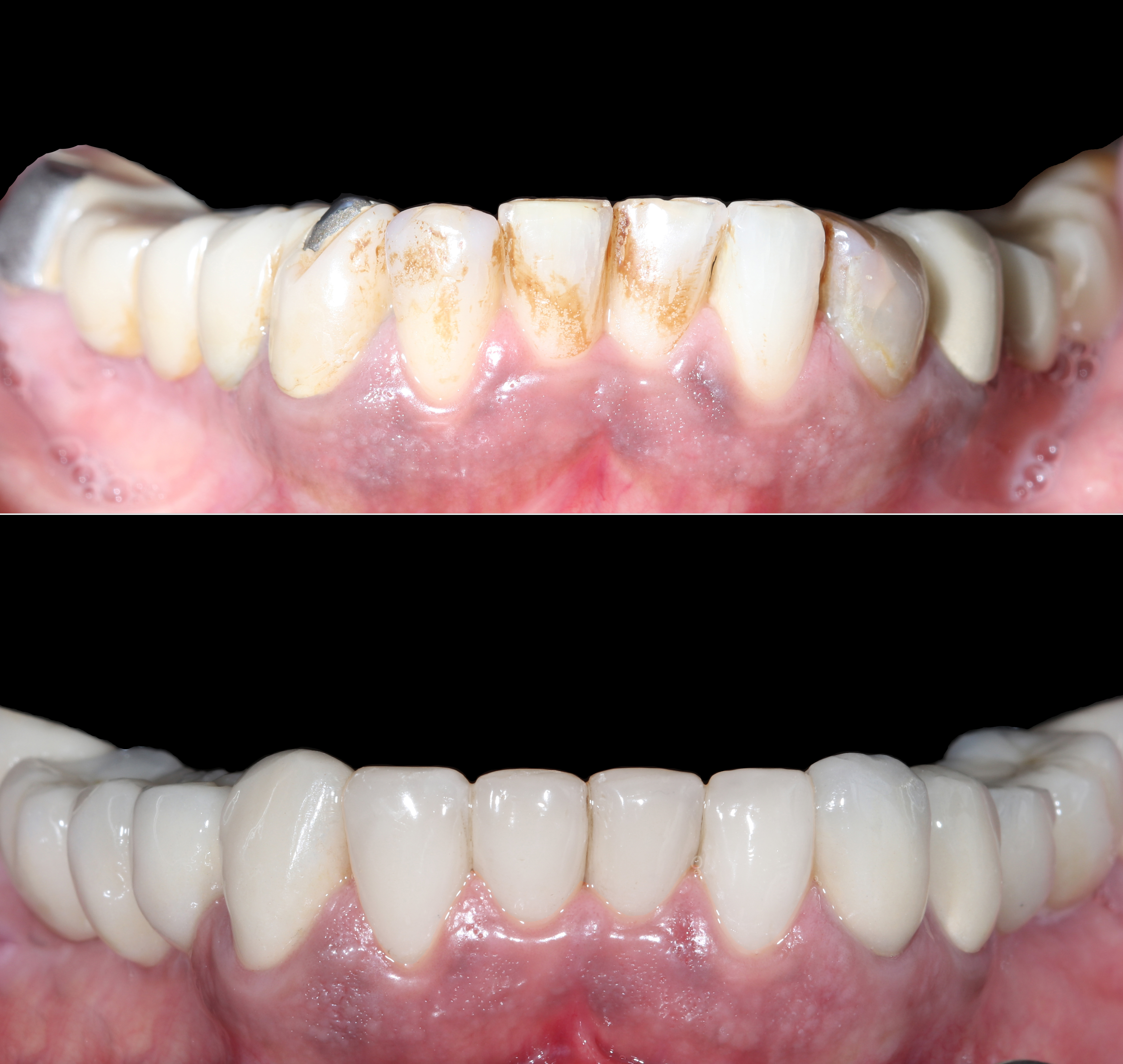 Σύγκριση αρχικής και τελικής κατάστασης στην κάτω γνάθο - Πρόσθια άποψη με χρήση contraster για ανάδειξη του αποτελέσματος