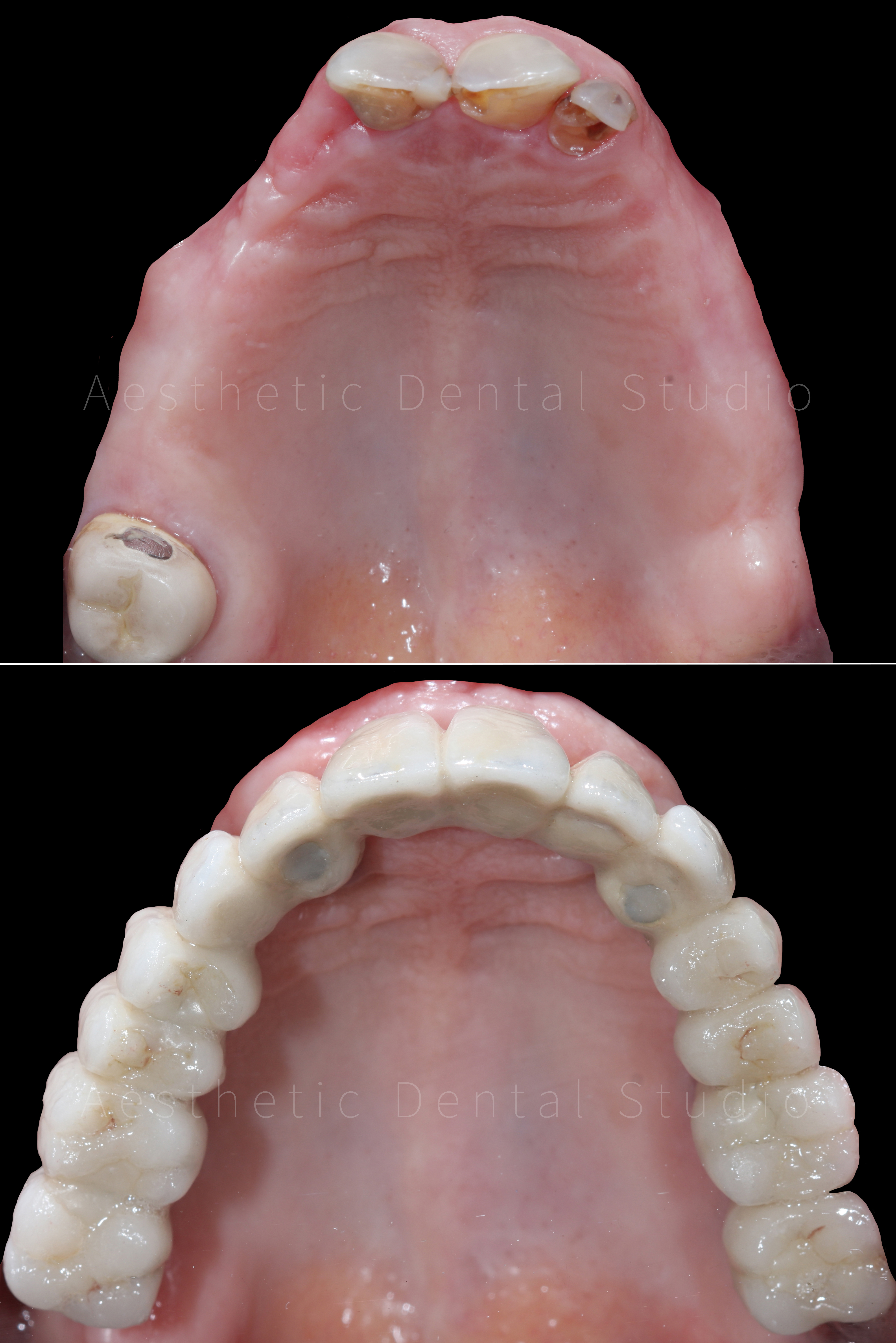 Άνω γνάθος — από εκτεταμένη φθορά και απώλεια δοντιών σε πλήρη αποκατάσταση με κεραμική γέφυρα επί εμφυτευμάτων, με ιδανική σύγκλειση και αισθητική