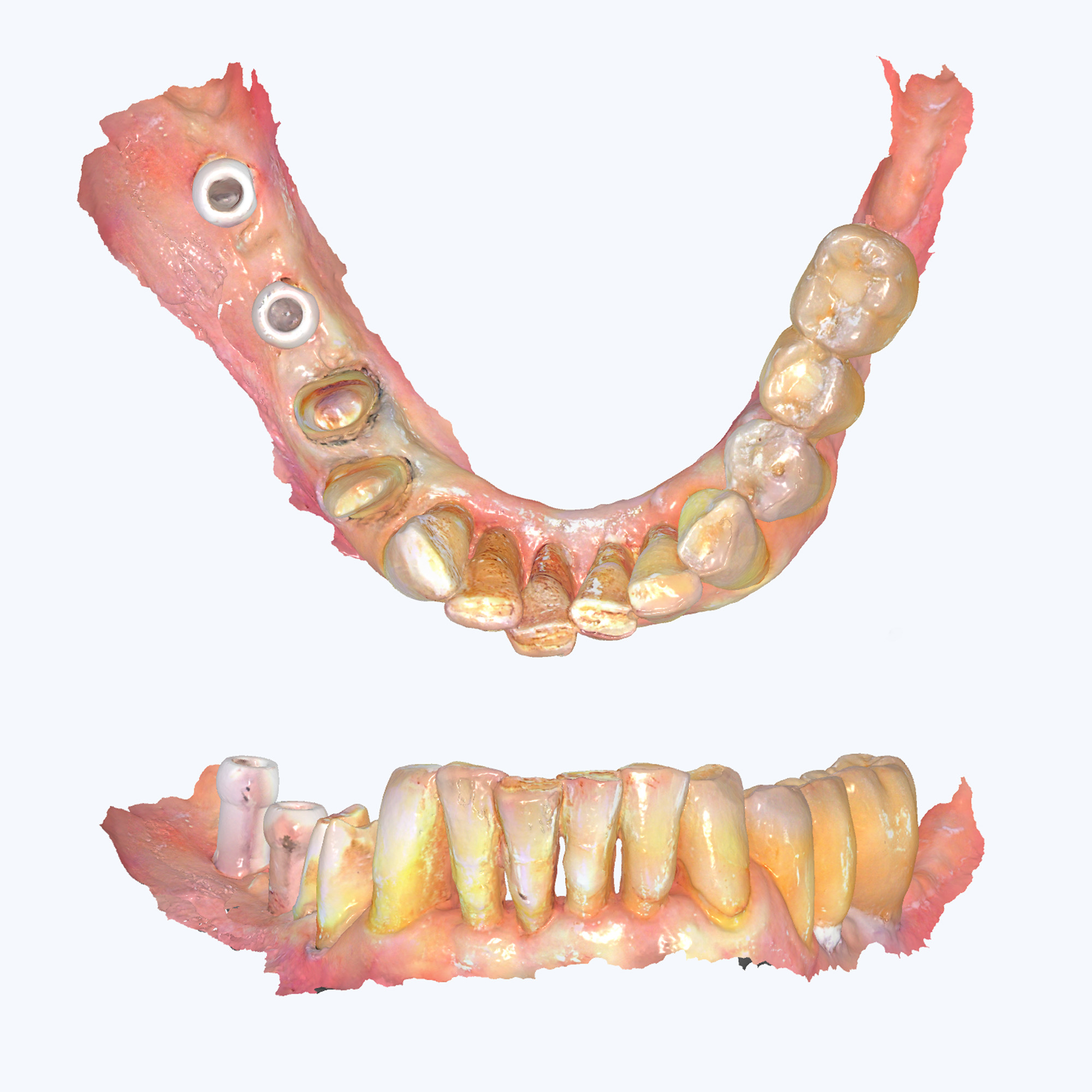 Ψηφιακή απεικόνιση των δοντιών και του χειρουργικού οδηγού, όπως δημιουργείται με τη βοήθεια ενδοστοματικού σαρωτή. Η τεχνολογία αυτή επιτρέπει ακριβή τοποθέτηση εμφυτευμάτων και άψογη προσαρμογή των προσθετικών εργασιών, εξασφαλίζοντας ασφάλεια και προβλεψιμότητα στο τελικό αποτέλεσμα.