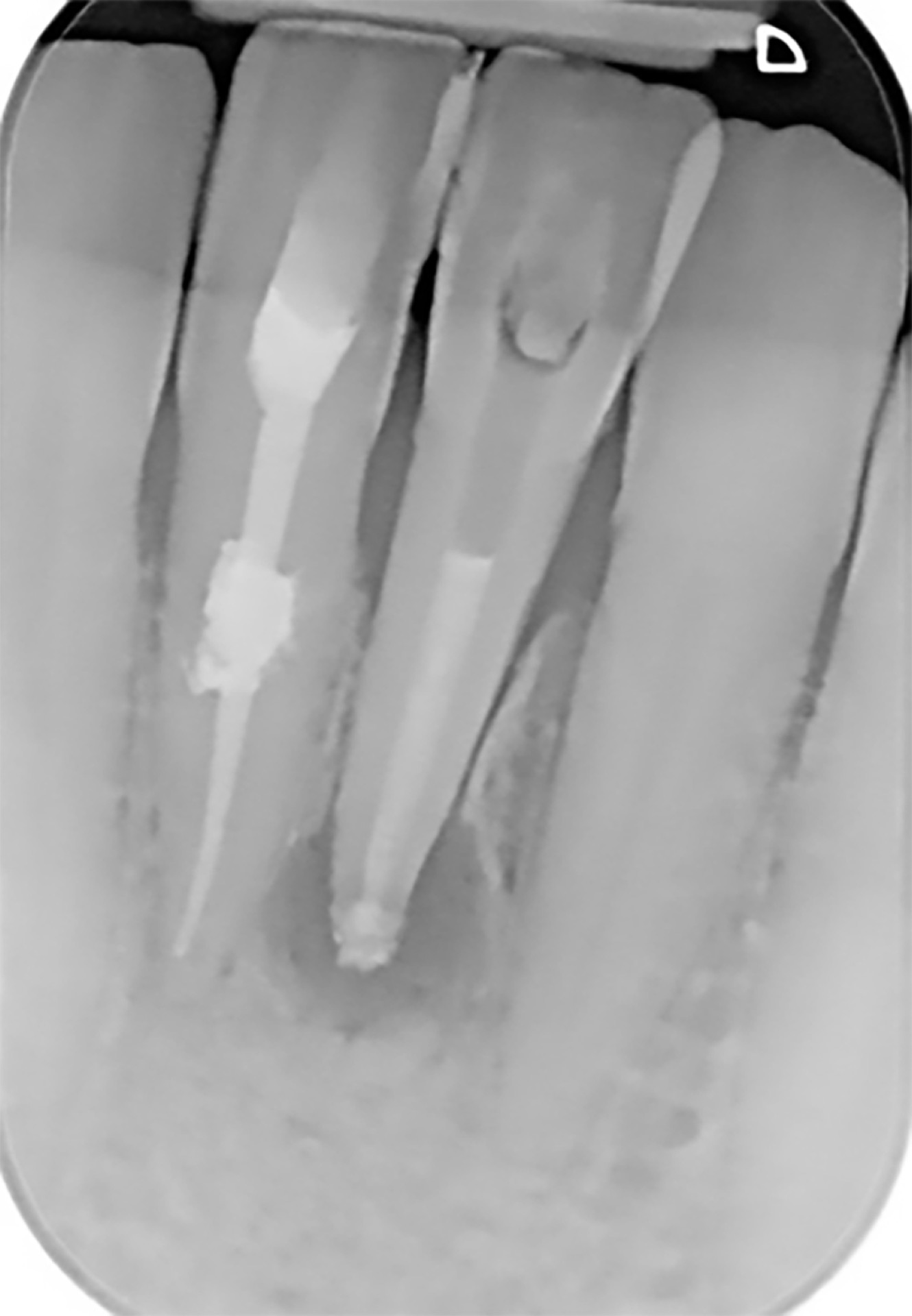 Ακτινογραφία μετά τις επιτυχείς ενδοδοντικές θεραπείες (απονευρώσεις) του πλάγιου και του κεντρικού τομέα της αριστερής πλευράς της κάτω γνάθου