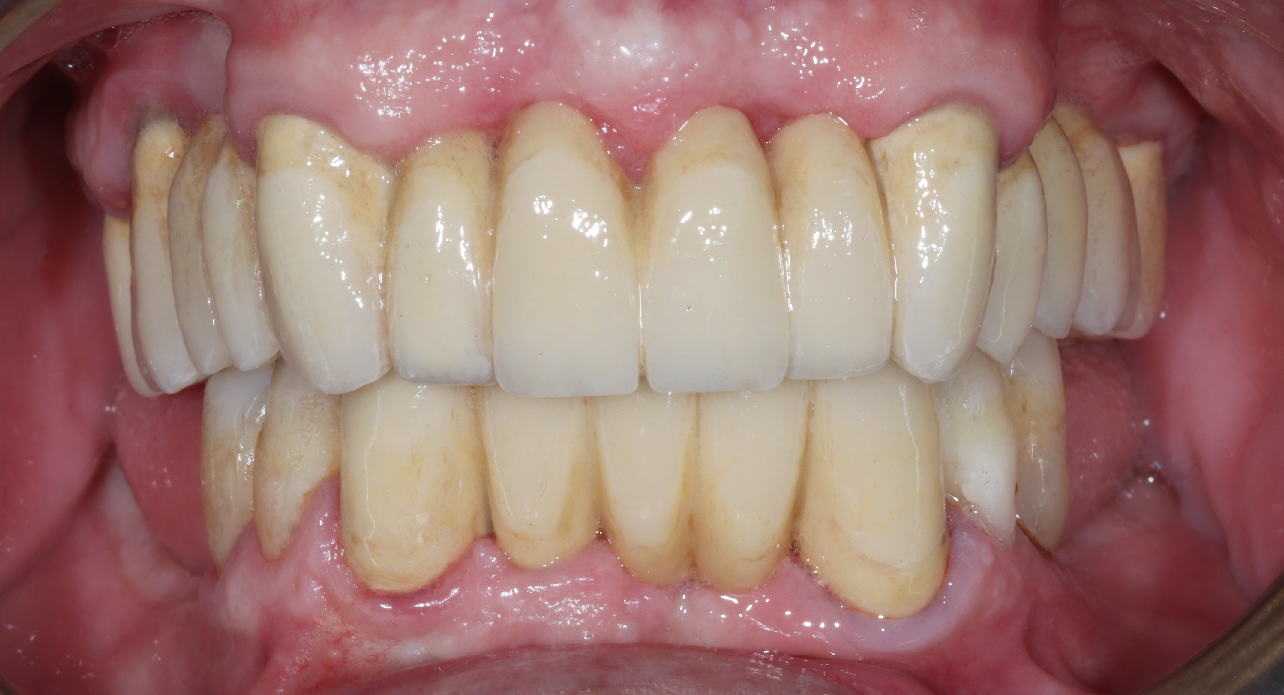 Τελική κατάσταση - Πρόσθια άποψη με τα δόντια σε σύγκλειση