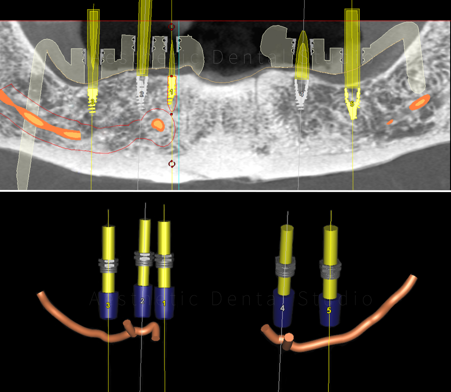 Ψηφιακός σχεδιασμός εμφυτευμάτων κάτω γνάθου — καθορισμός θέσης και κλίσης εμφυτευμάτων σε σχέση με το κάτω φατνιακό νεύρο για ασφαλή και ακριβή τοποθέτηση