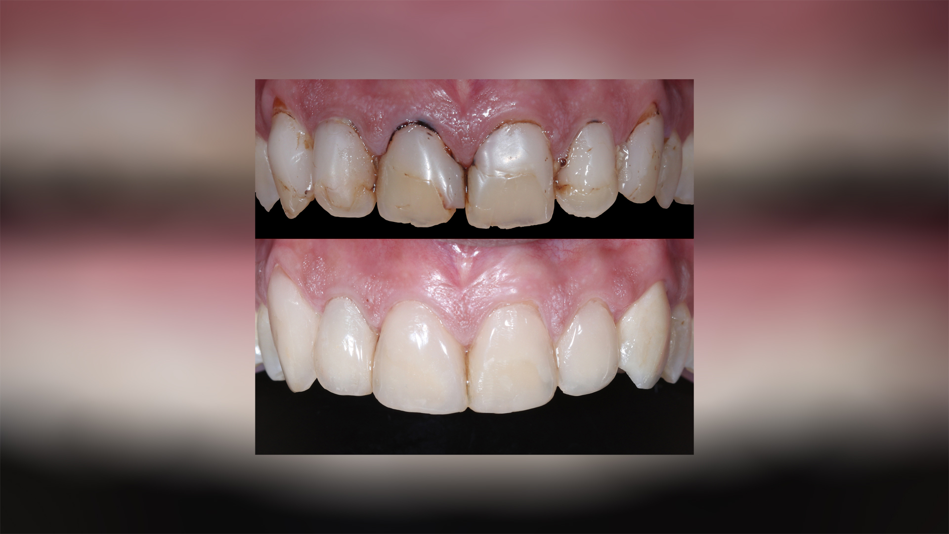 Cosmetic rehabilitation of upper anterior teeth with composite veneers - Dr. Klironomos