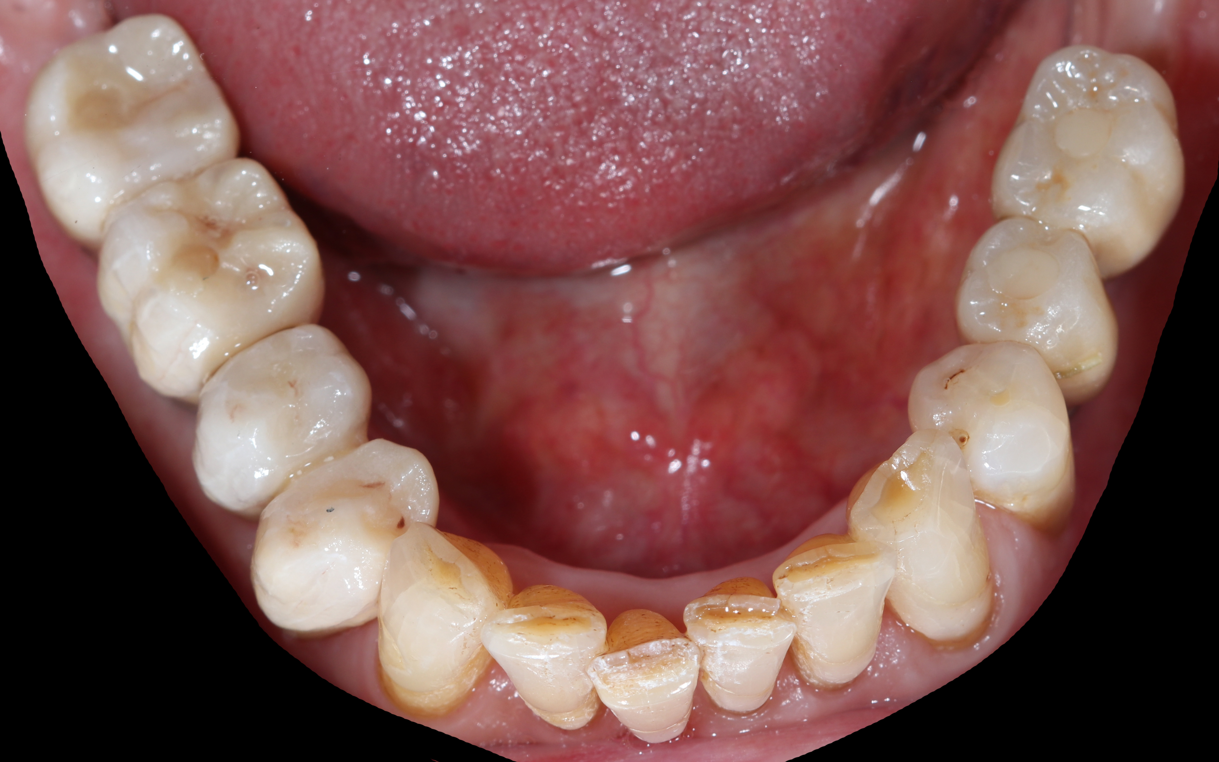 Τελική κατάσταση - Μασητική άποψη