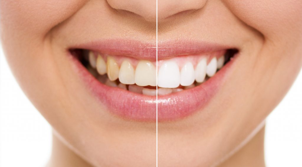 Tooth Bleaching - Main Image