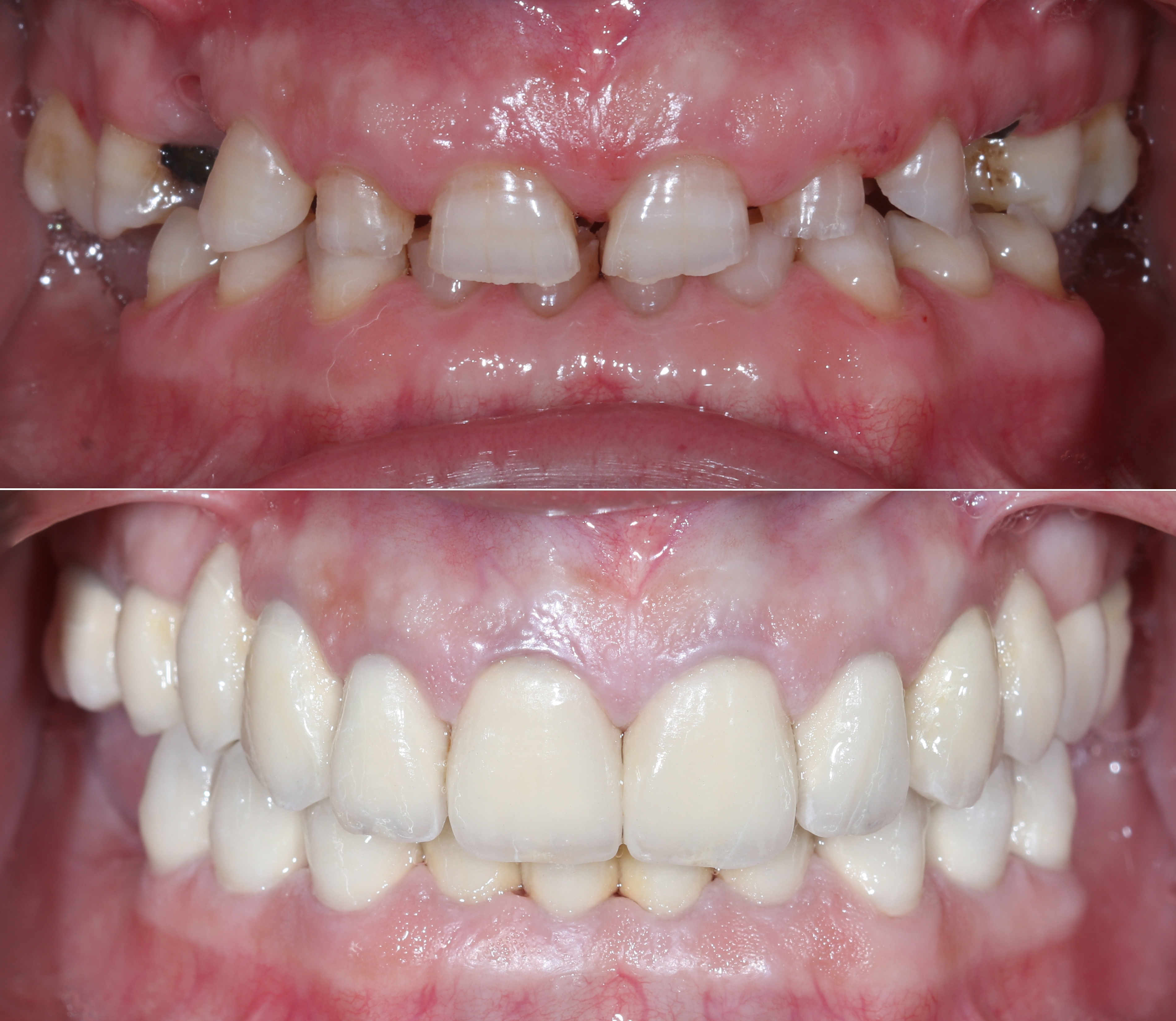 Σύγκριση αρχικής και τελικής κατάστασης – Πρόσθια άποψη του στόματος πριν και μετά την προσθετική αποκατάσταση