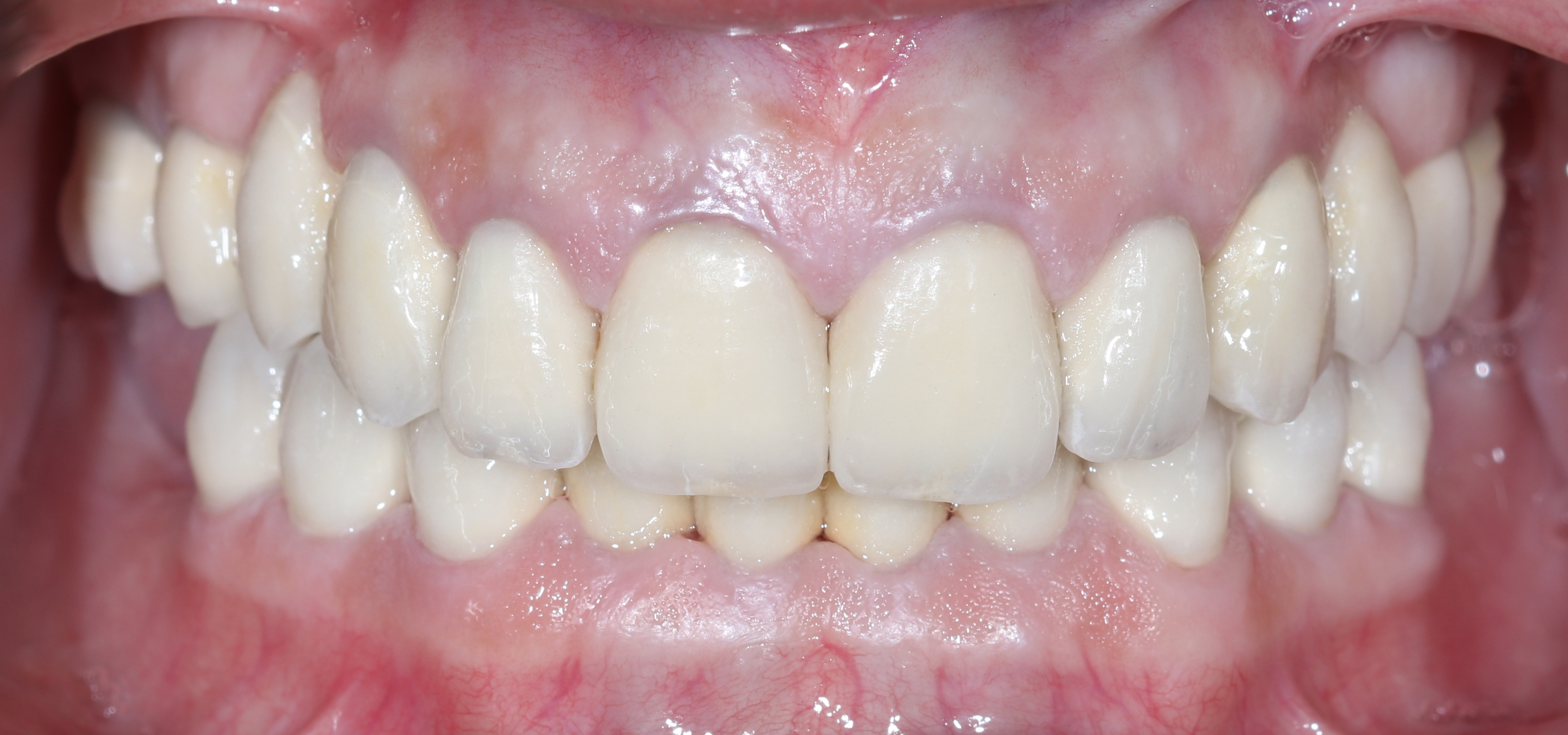 Τελική κατάσταση - Πρόσθια άποψη