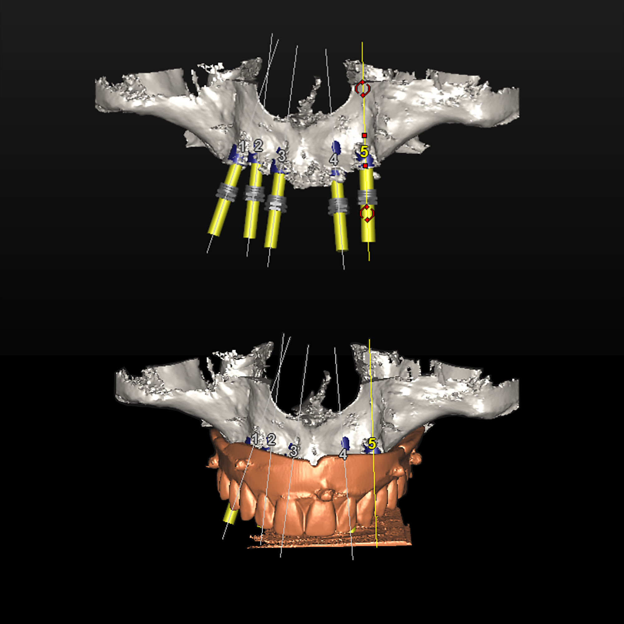 Πάνω: τα πέντε εμφυτεύματα ψηφιακά («εικονικά») τοποθετημένα στην τρισδιάστατη αναπαράσταση του οστού της άνω γνάθου της ασθενούς - Κάτω: Προεπισκόπιση του χειρουργικού νάρθηκα («οδηγού») που θα χρησιμοποιηθεί για την μεταφορά της θέσης των εμφυτευμάτων στην γνάθο του ασθενούς κατά το χειρουργείο, σε απόλυτη ταύτιση με τον ψηφιακό σχεδιασμό μας