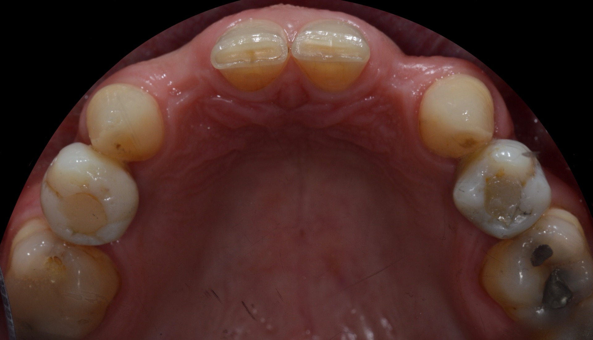 Τα εμφυτεύματα τοποθετημένα στην άνω γνάθο με προσωρινές στεφάνες για την αισθητική διαμόρφωση των ούλων.