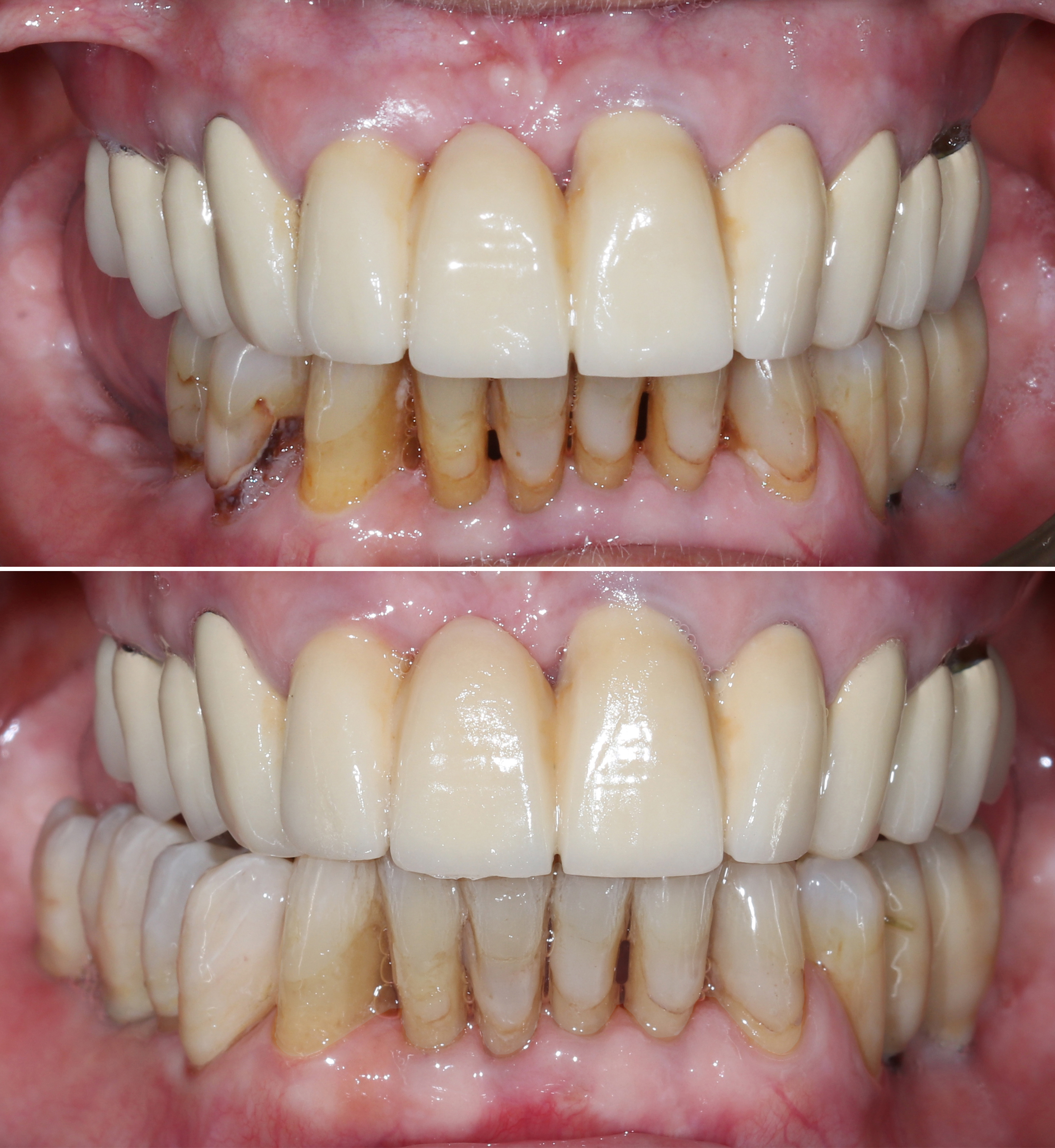 Σύγκριση αρχικής και τελικής κατάστασης – Πρόσθια άποψη του χαμόγελου πριν και μετά την αποκατάσταση
