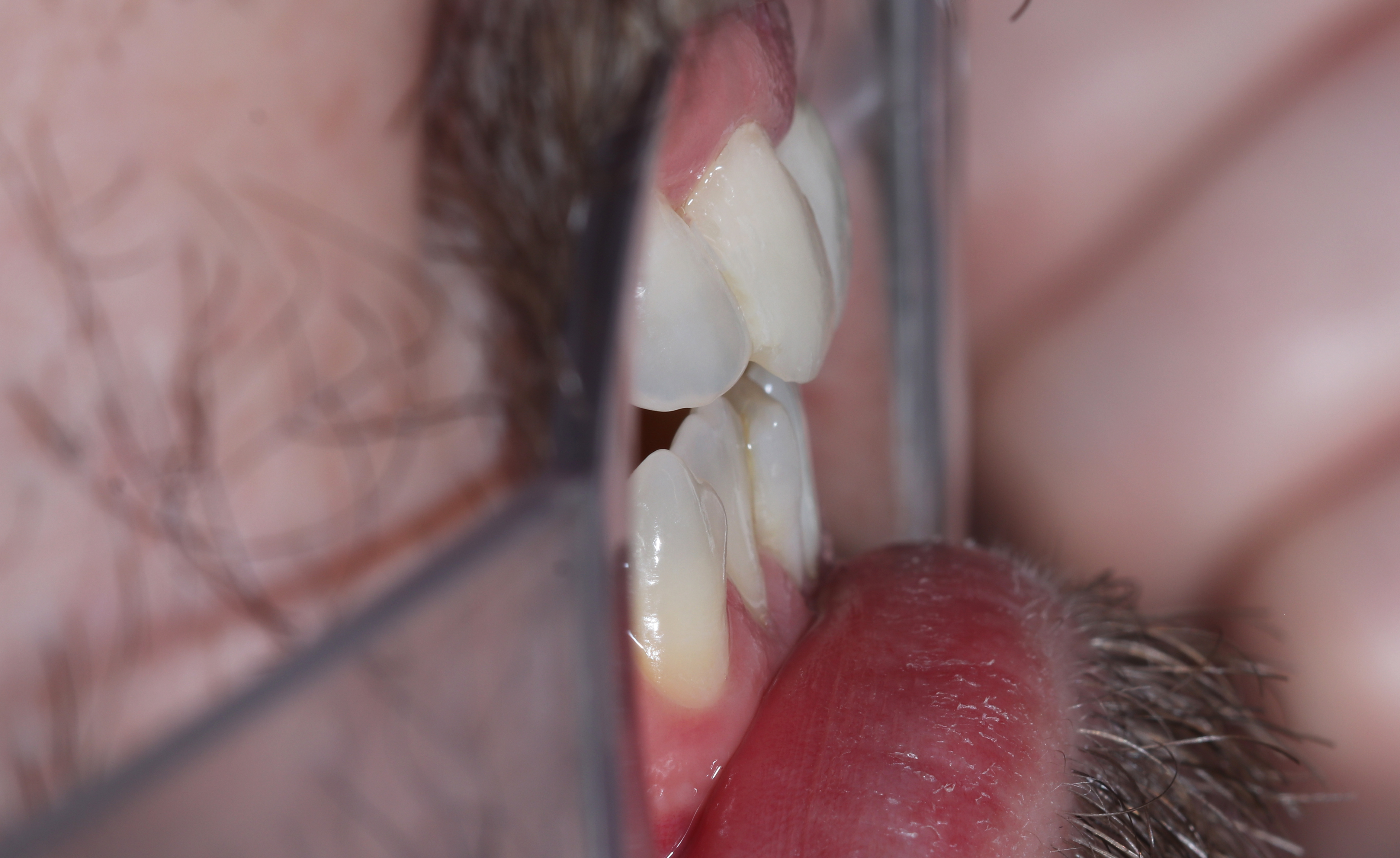 Οι προσωρινές αποκαταστάσεις τοποθετημένες στο στόμα μετά την παρασκευή των δοντιών - Προφίλ