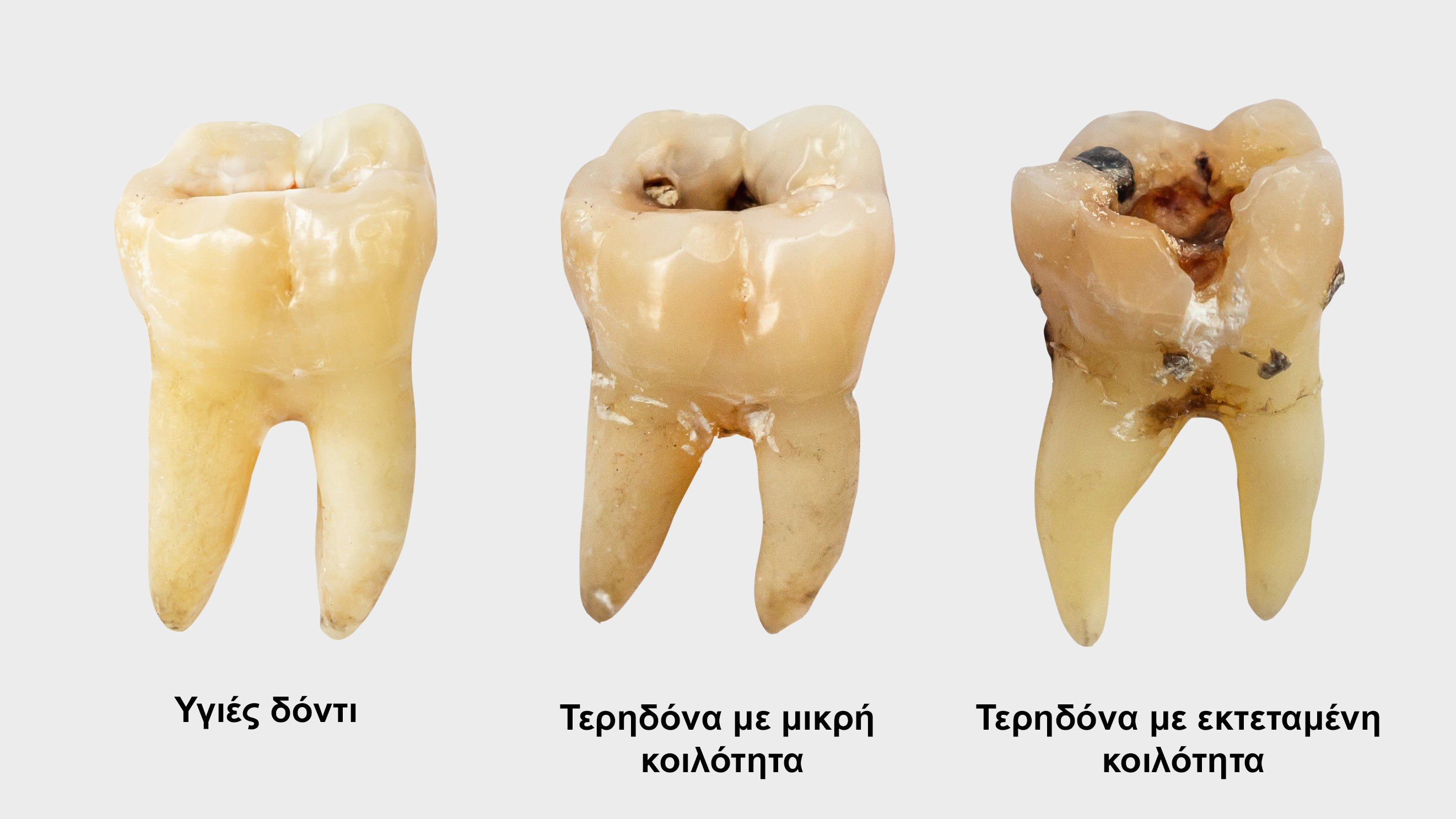 Εμφράξεις Δοντιών (Σφραγίσματα)