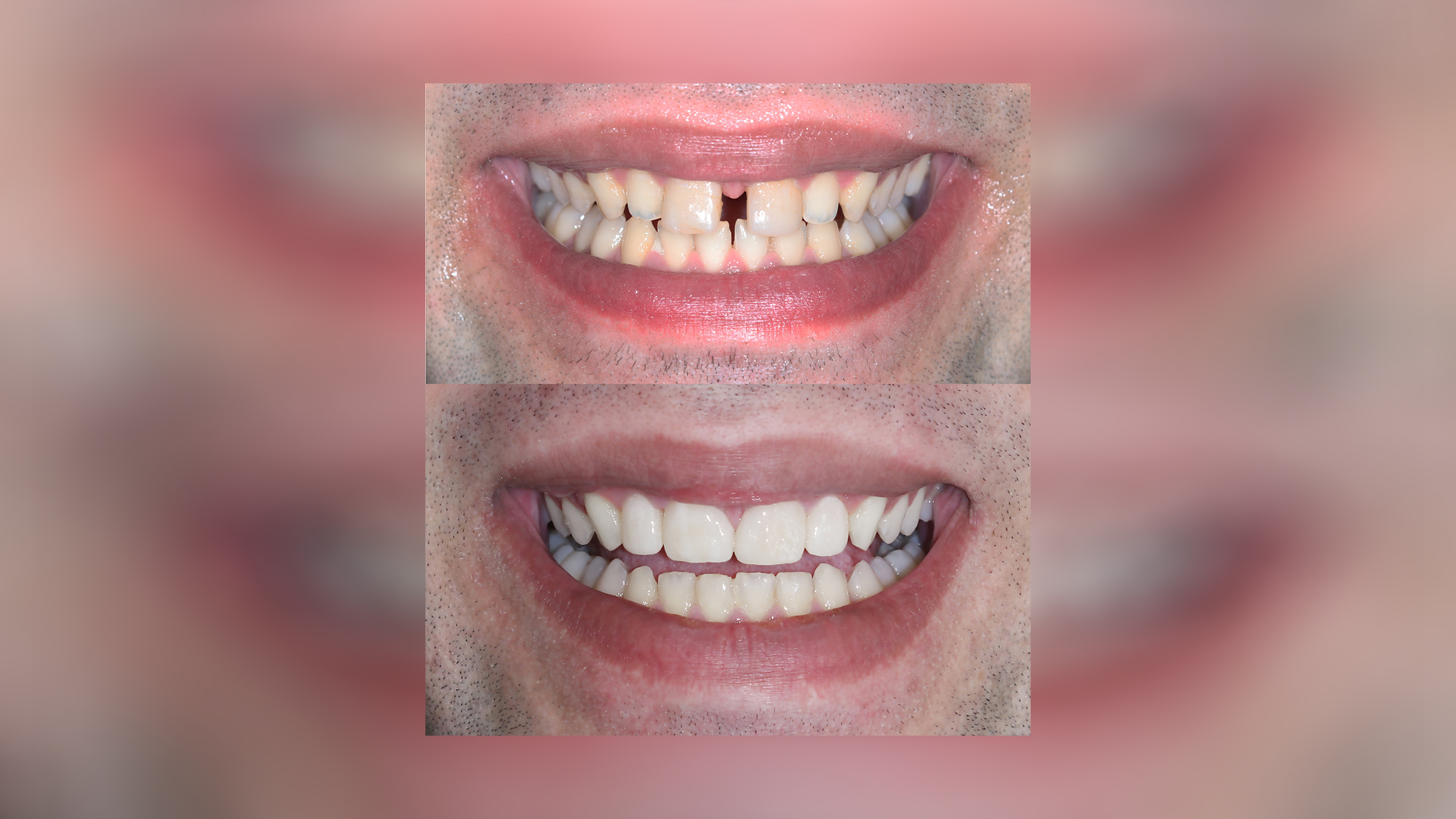 Diastema closure of upper front teeth with porcelain veneers - Dr. Klironomos