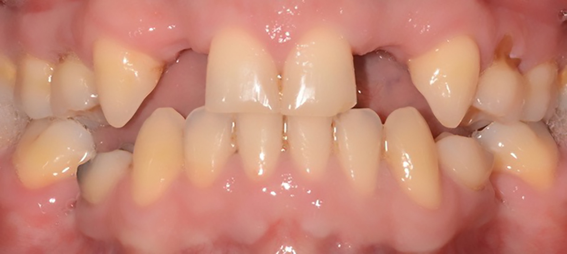 Αρχική κατάσταση - Πρόσθια άποψη (σε σύγκλειση).