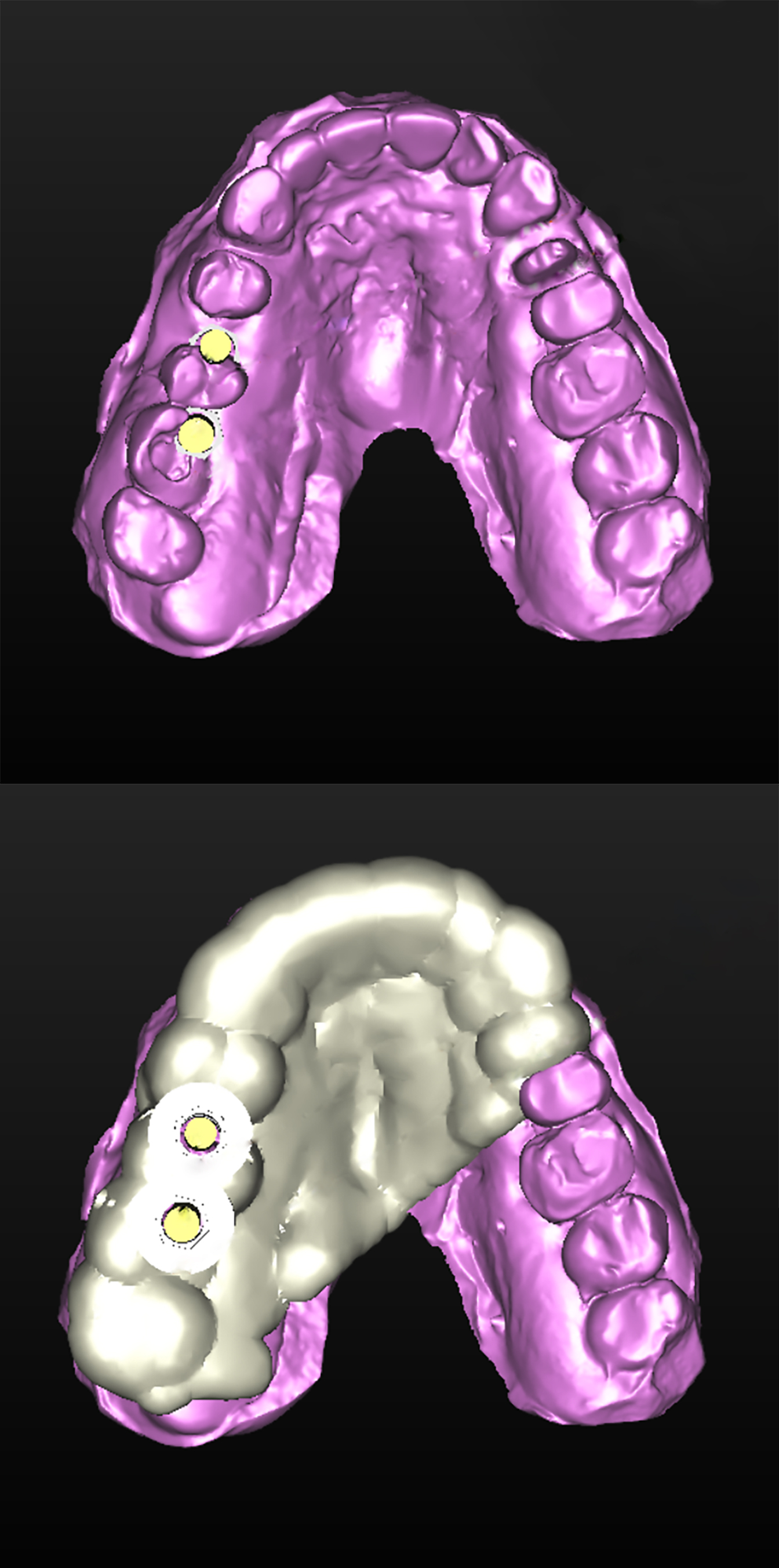 Τα δύο εμφυτεύματα εικονικώς τοποθετημένα στο ψηφιακό ομοίωμα της άνω γνάθου και η σχεδίαση του χειρουργικού οδηγού από το ειδικό οδοντιατρικό λογισμικό προεγχειρητικής τοποθέτησης εμφυτευμάτων