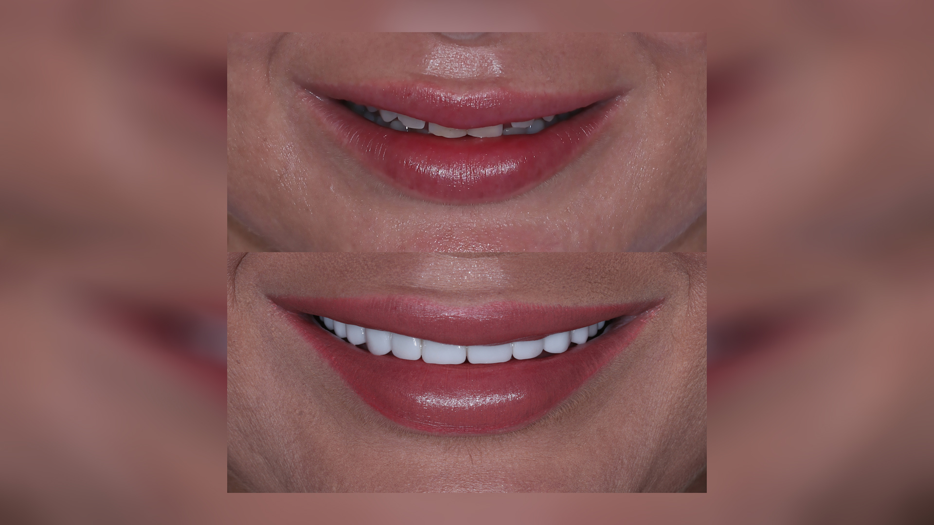 Comprehensive smile makeover with porcelain veneers - Dr. Klironomos