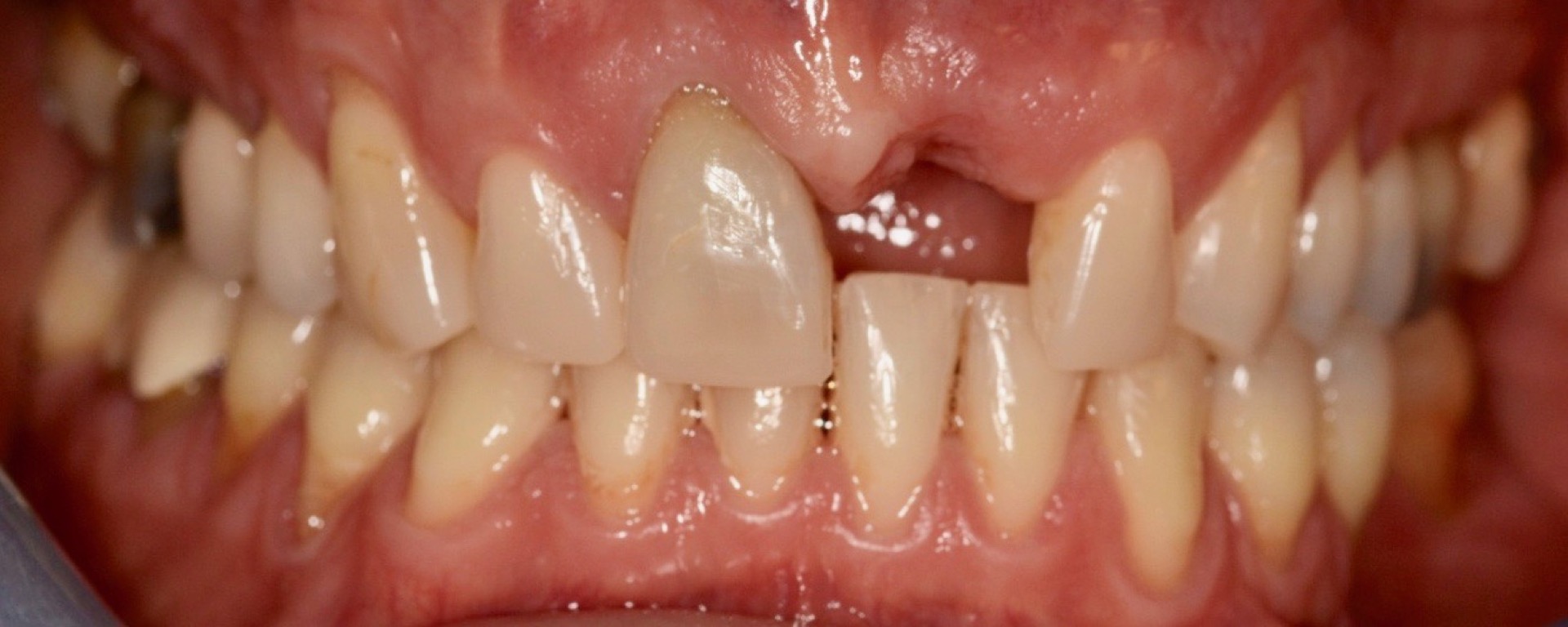 Αρχική κατάσταση - Πρόσθια άποψη