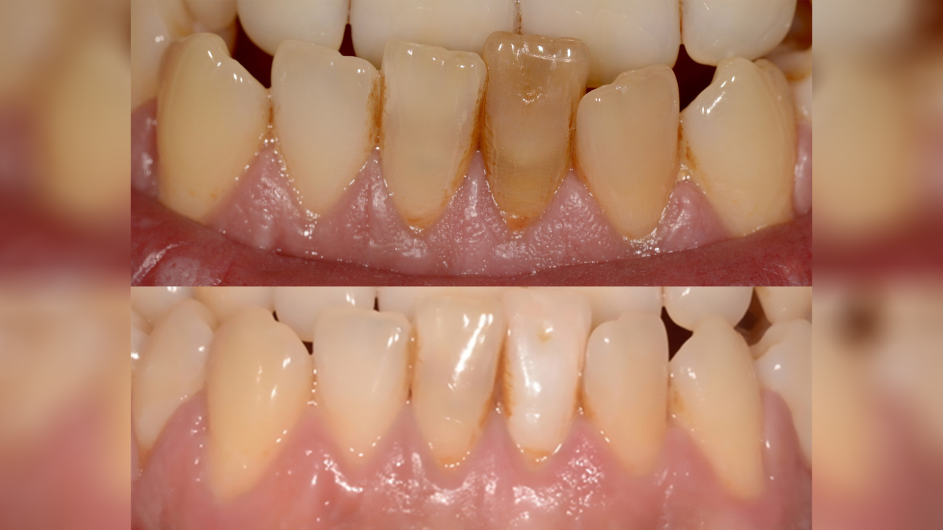 Internal bleaching of a non-vital discolored tooth - Dr. Klironomos