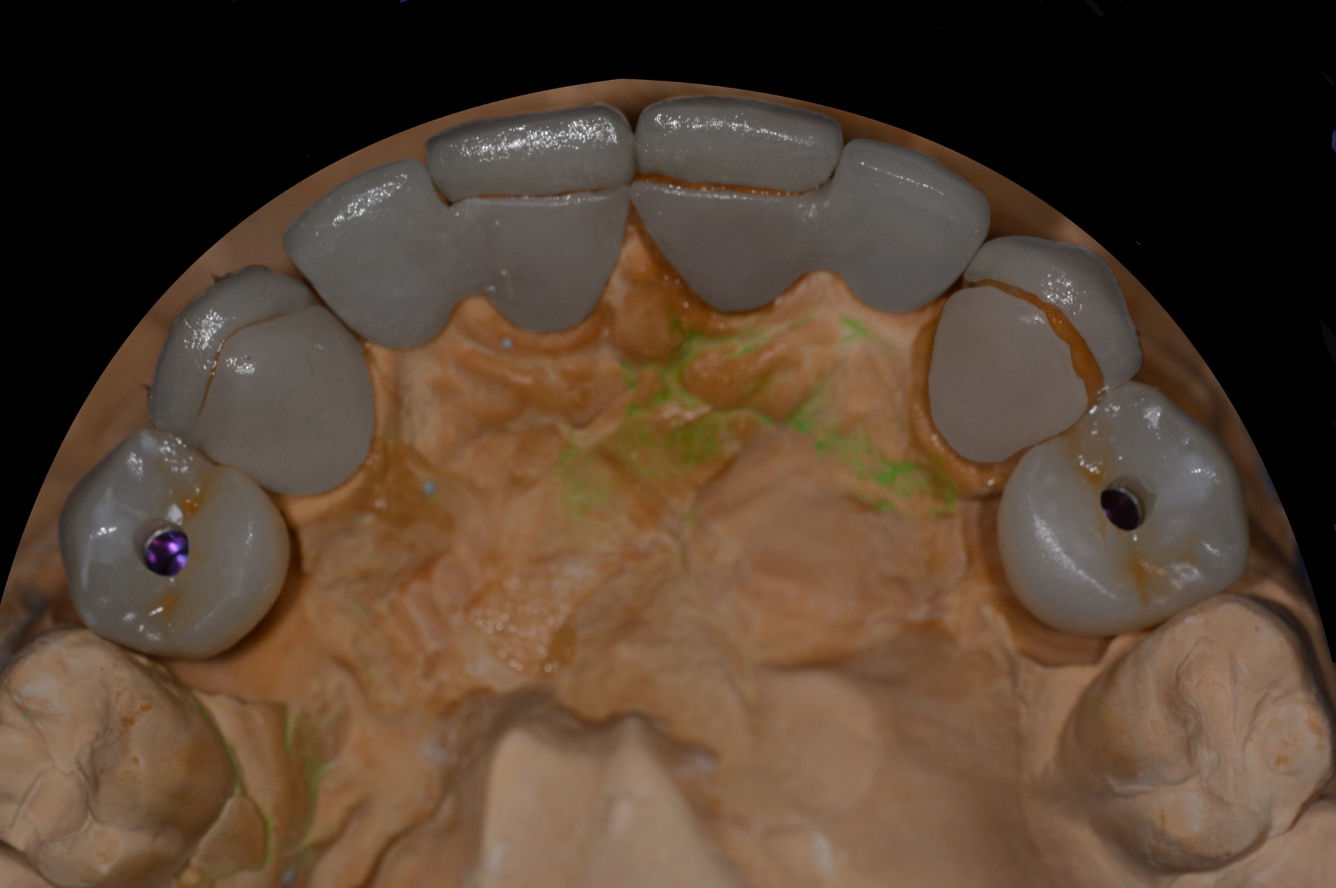 Μασητική άποψη των αποκαταστάσεων της άνω γνάθου, στο γύψινο εκμαγείο, πριν την τοποθέτηση στο στόμα 