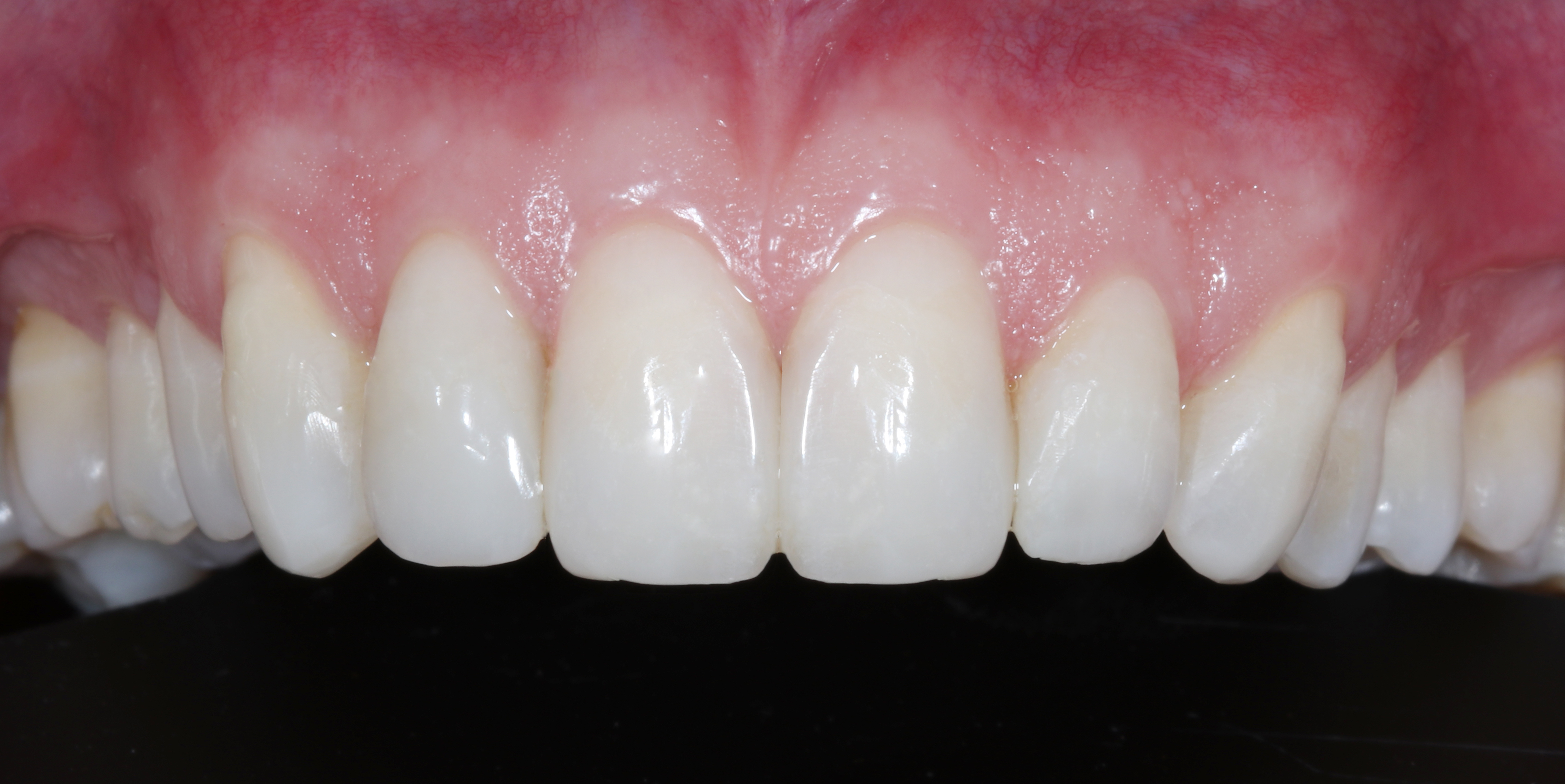 Πρόσθια άποψη με χρήση contraster για ανάδειξη του αποτελέσματος