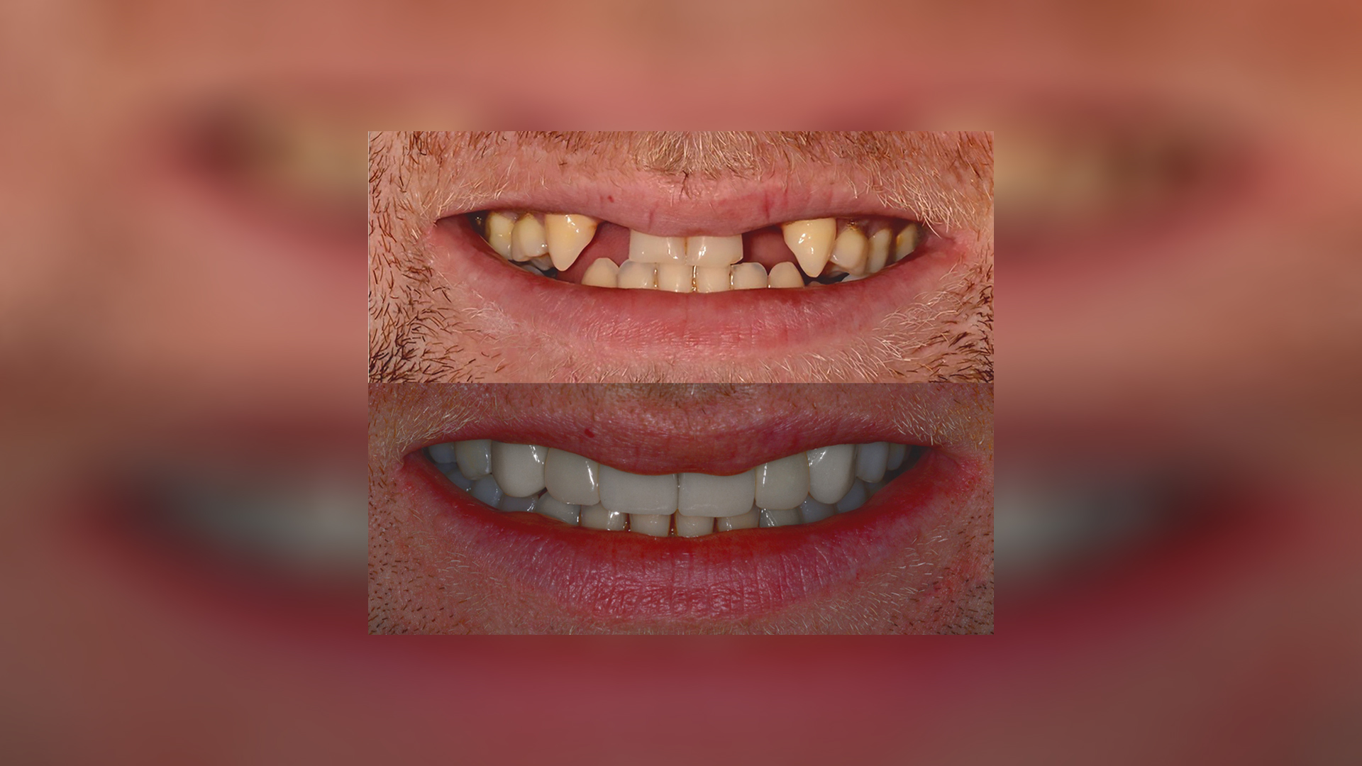 Full-mouth rehabilitation of congenital tooth loss using implants and ceramic restorations - Dr. Klironomos