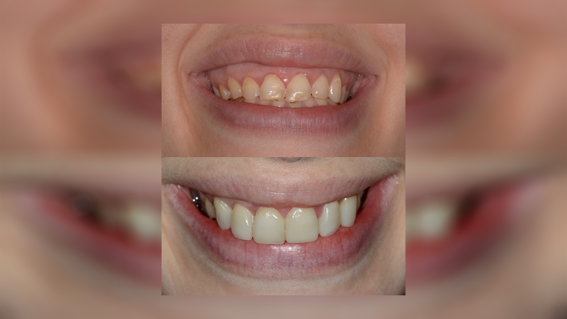 Full-mouth rehabilitation of worn dentition with all-ceramic restorations of full and partial coverage - Dr. Klironomos