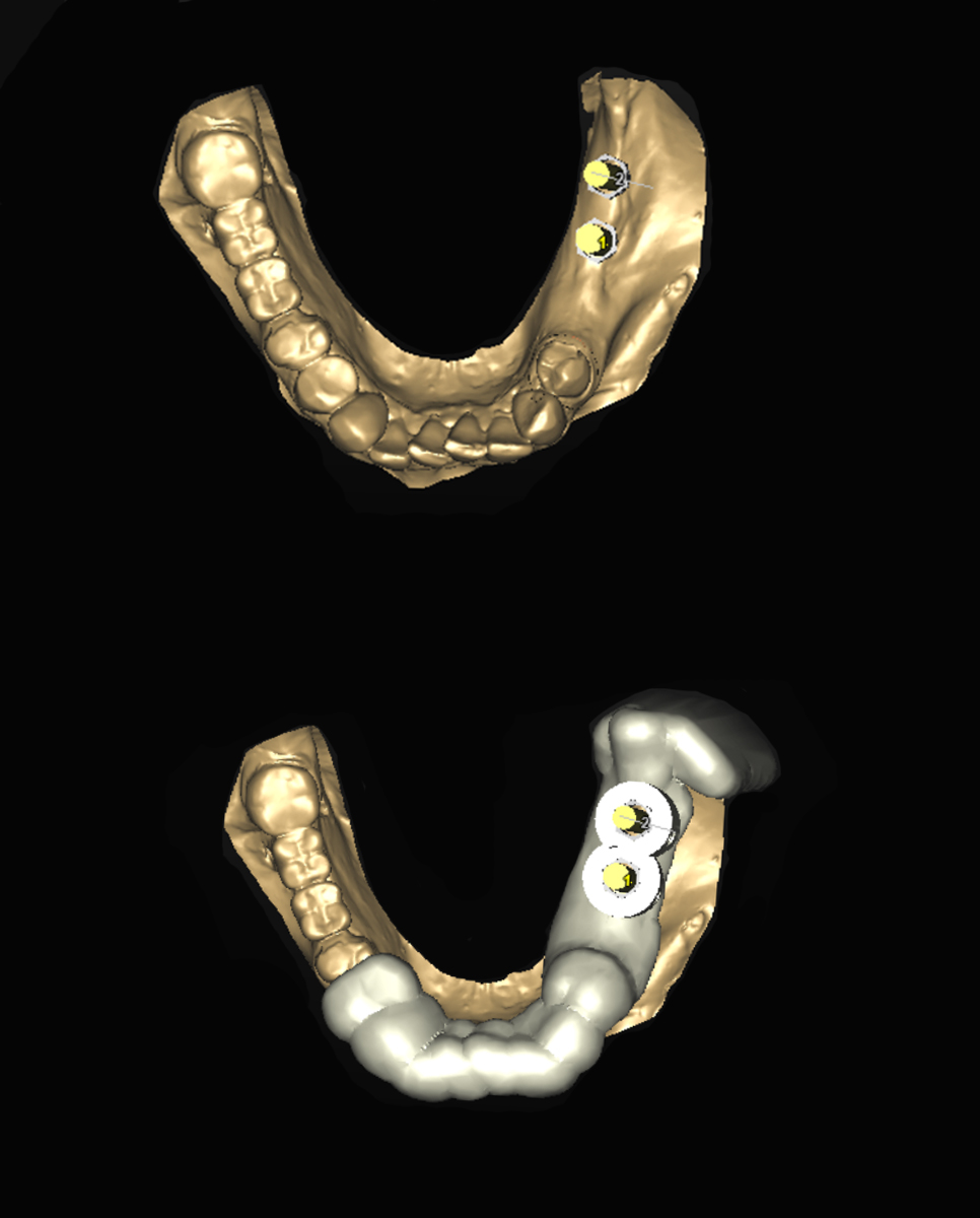 Ψηφιακός σχεδιασμός για την χειρουργική τοποθέτηση των εμφυτευμάτων - Πάνω: Το ψηφιακό αποτύπωμα της κάτω γνάθου, ενώ φαίνονται και οι κατευθύνσεις των δύο εμφυτευμάτων που έχουν τοποθετηθεί ψηφιακά - Κάτω: Το ψηφιακό αποτύπωμα της κάτω γνάθου και ο χειρουργικός οδηγός για την τοποθέτηση των εμφυτευμάτων 