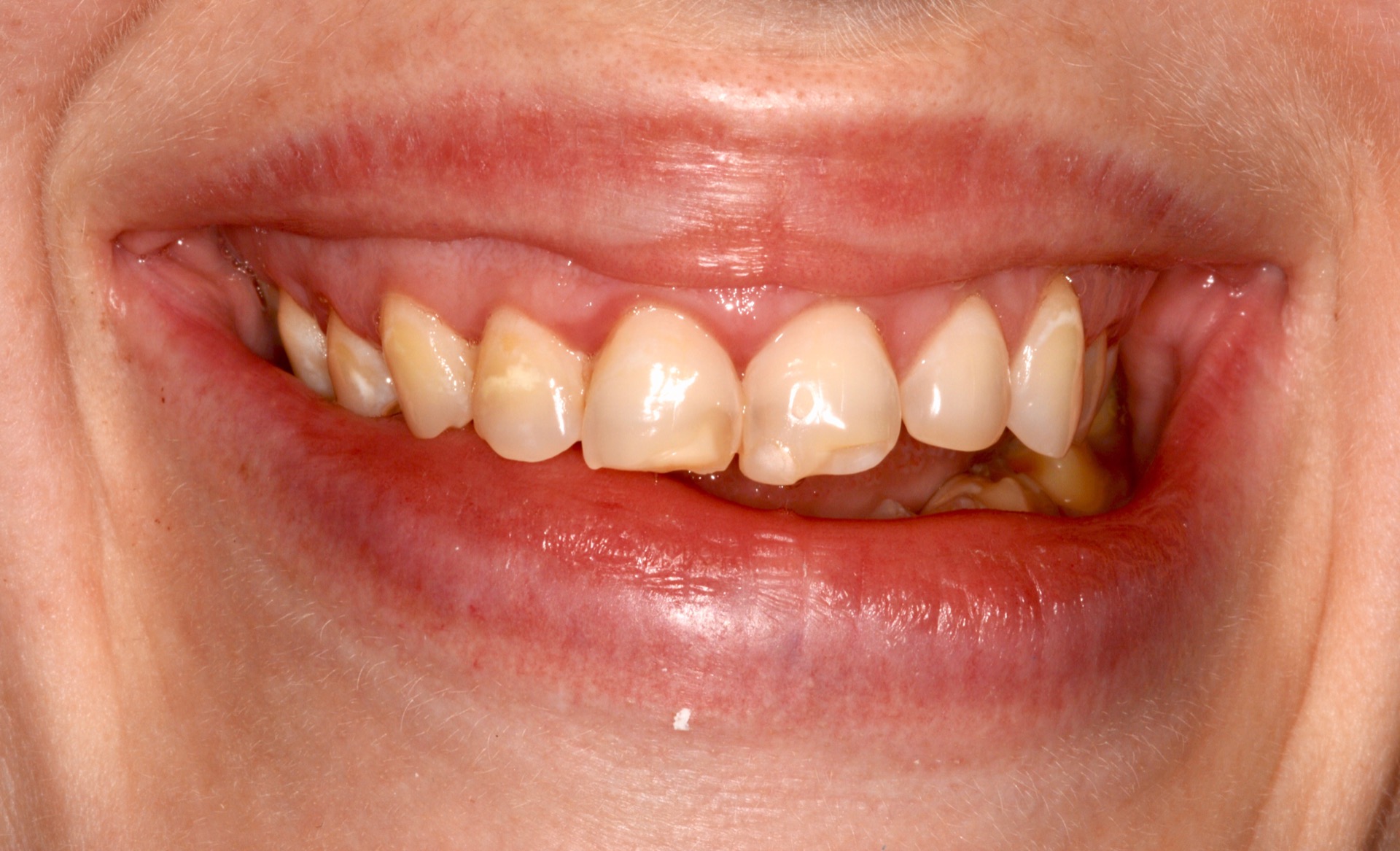 Τρεις μήνες μετά την αισθητική διαμόρφωση των ούλων - Αρμονικό περίγραμμα των ουλικών ζενίθ.