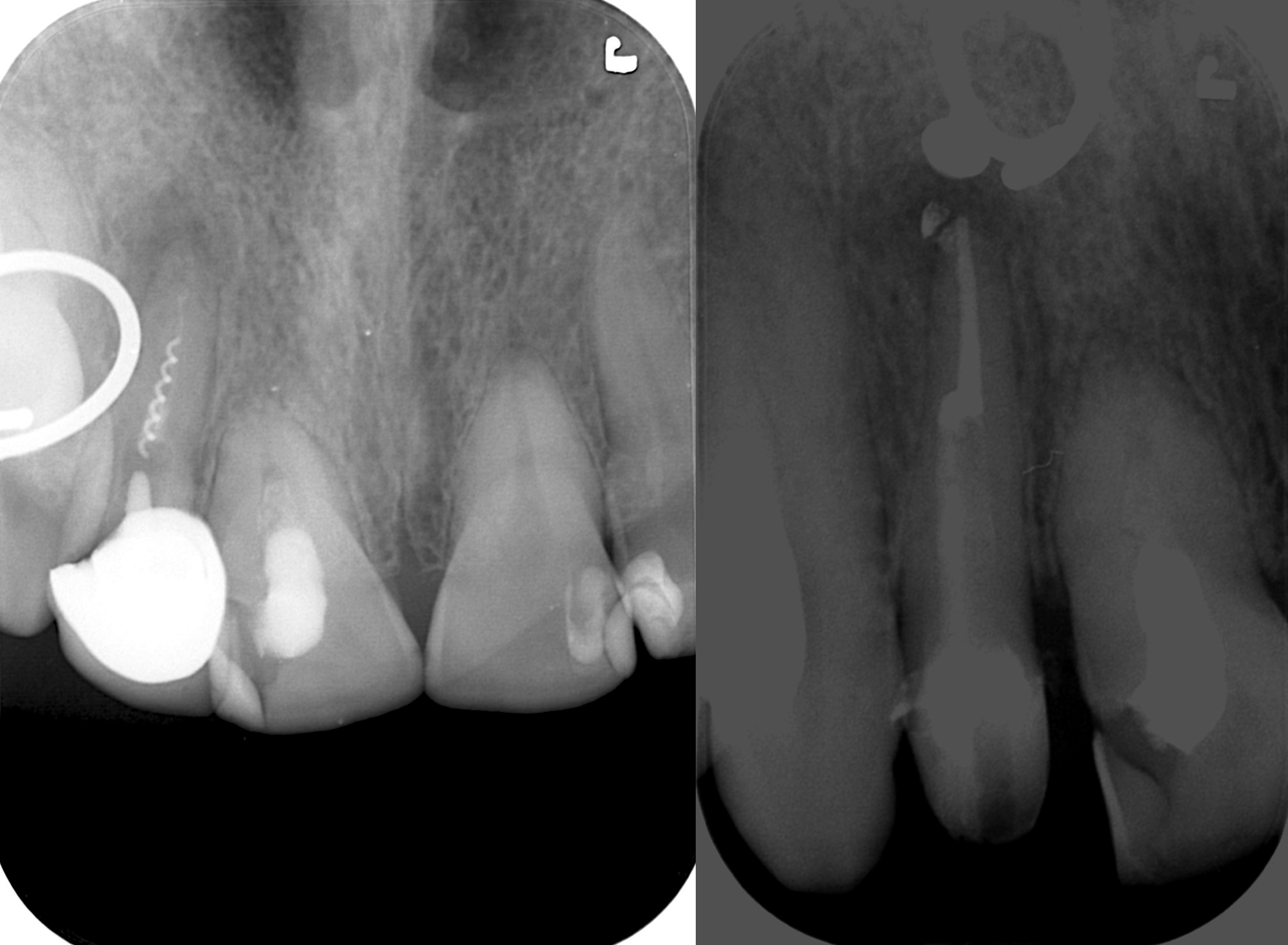 Επανάληψη ενδοδοντικής θερα�πείας στον άνω δεξιά πάγιο τομέα - Αφαίρεση σπασμένου εργαλείου απο τον προηγούμενο οδοντίατρο και τοποθέτηση άξονα υαλονημάτων